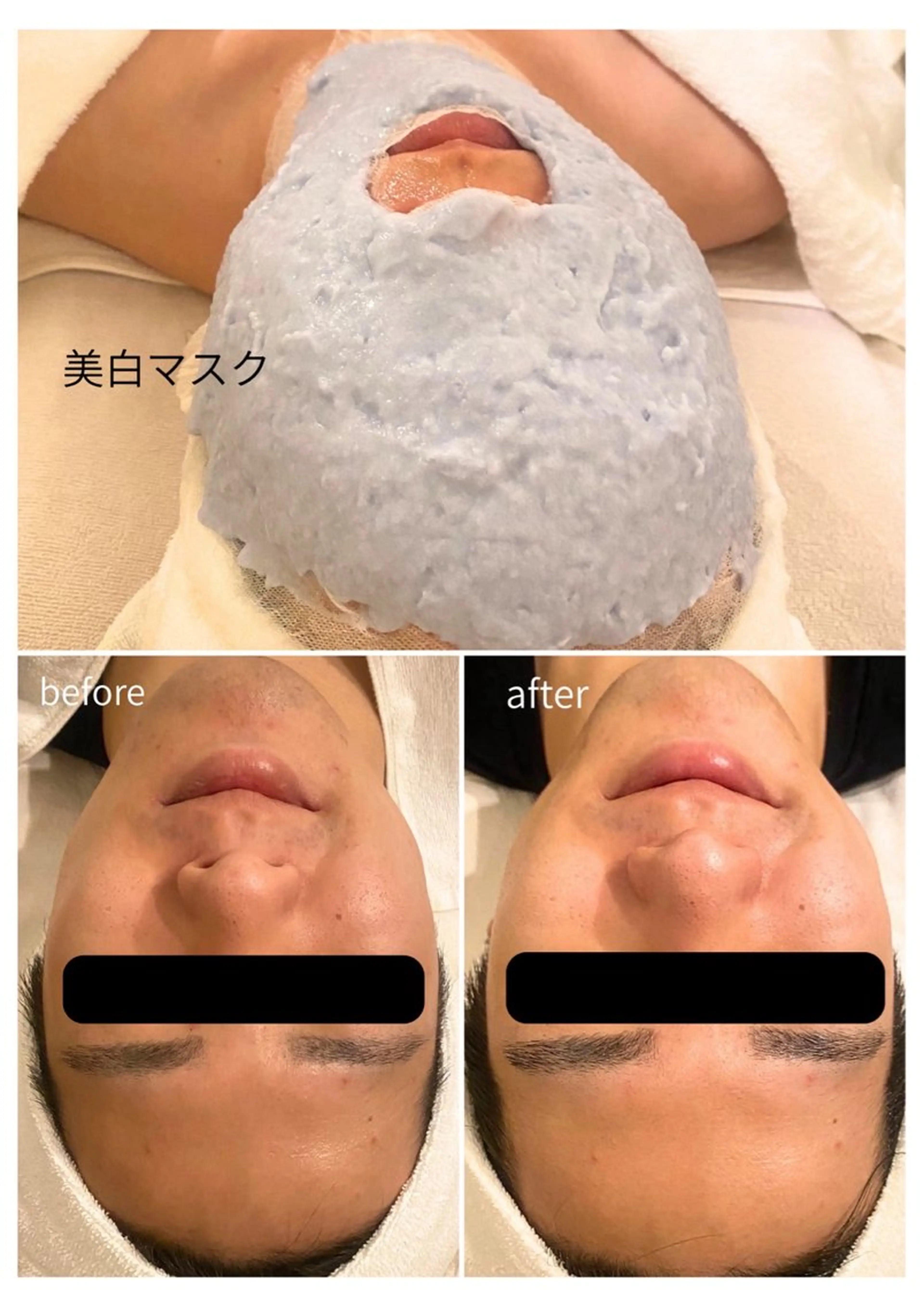 エステ リラク 毛穴/ピーリング ララピール/POLAのエステ・リラクイメージ