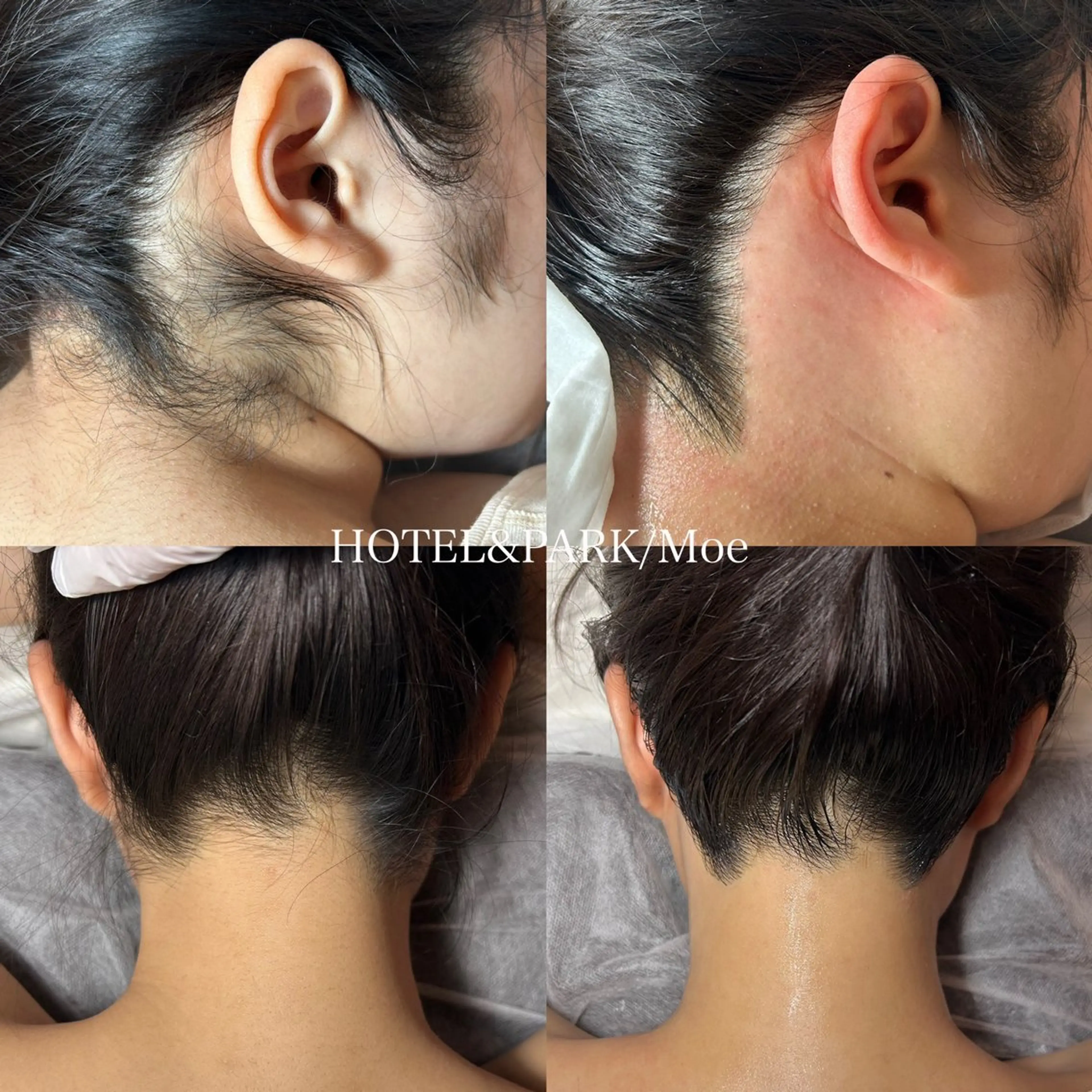 ☃️BIG SALE☃️  【うなじ+もみあげワックス脱毛】の写真