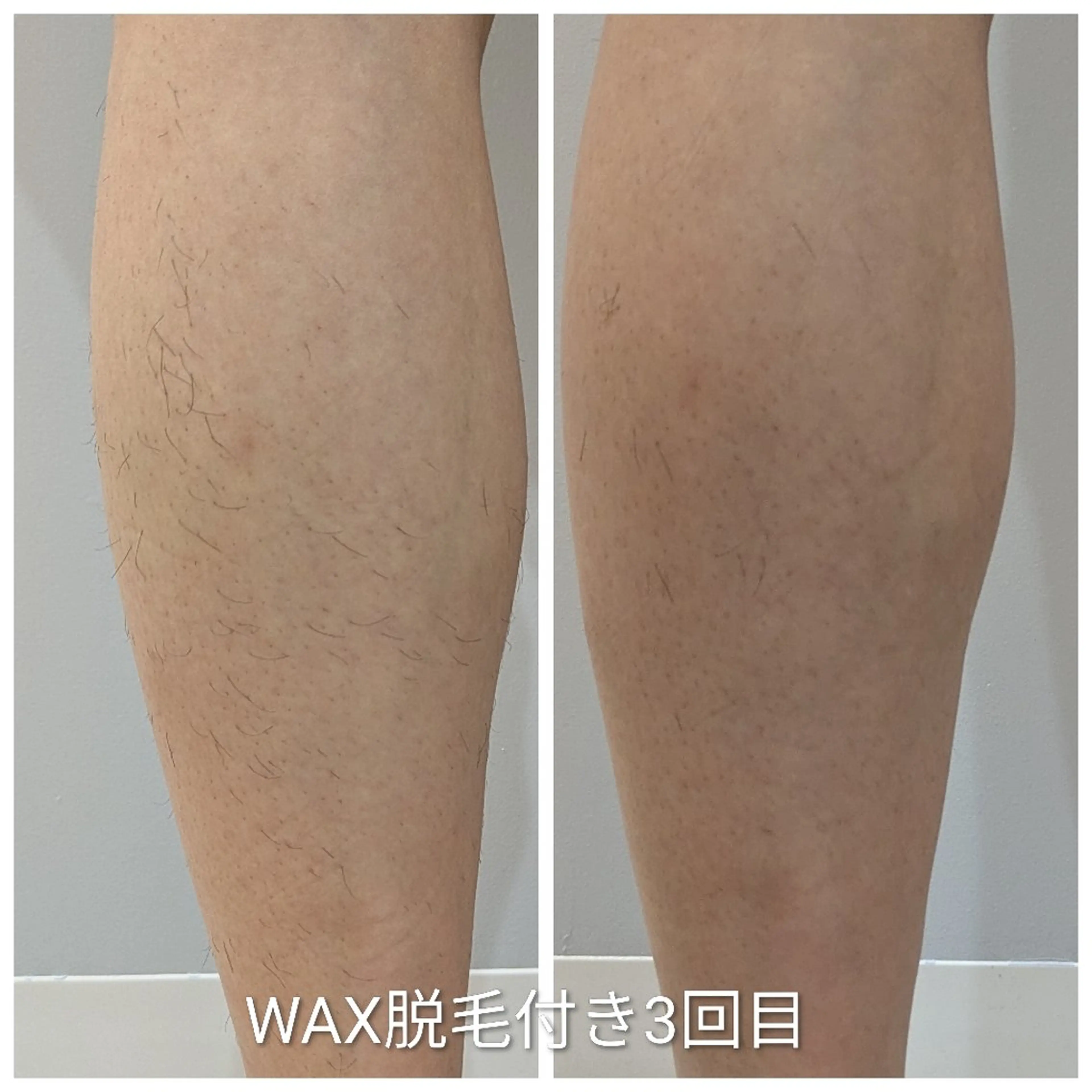 脚WAX脱毛付き光脱毛（一センチ以上伸びている方）の写真
