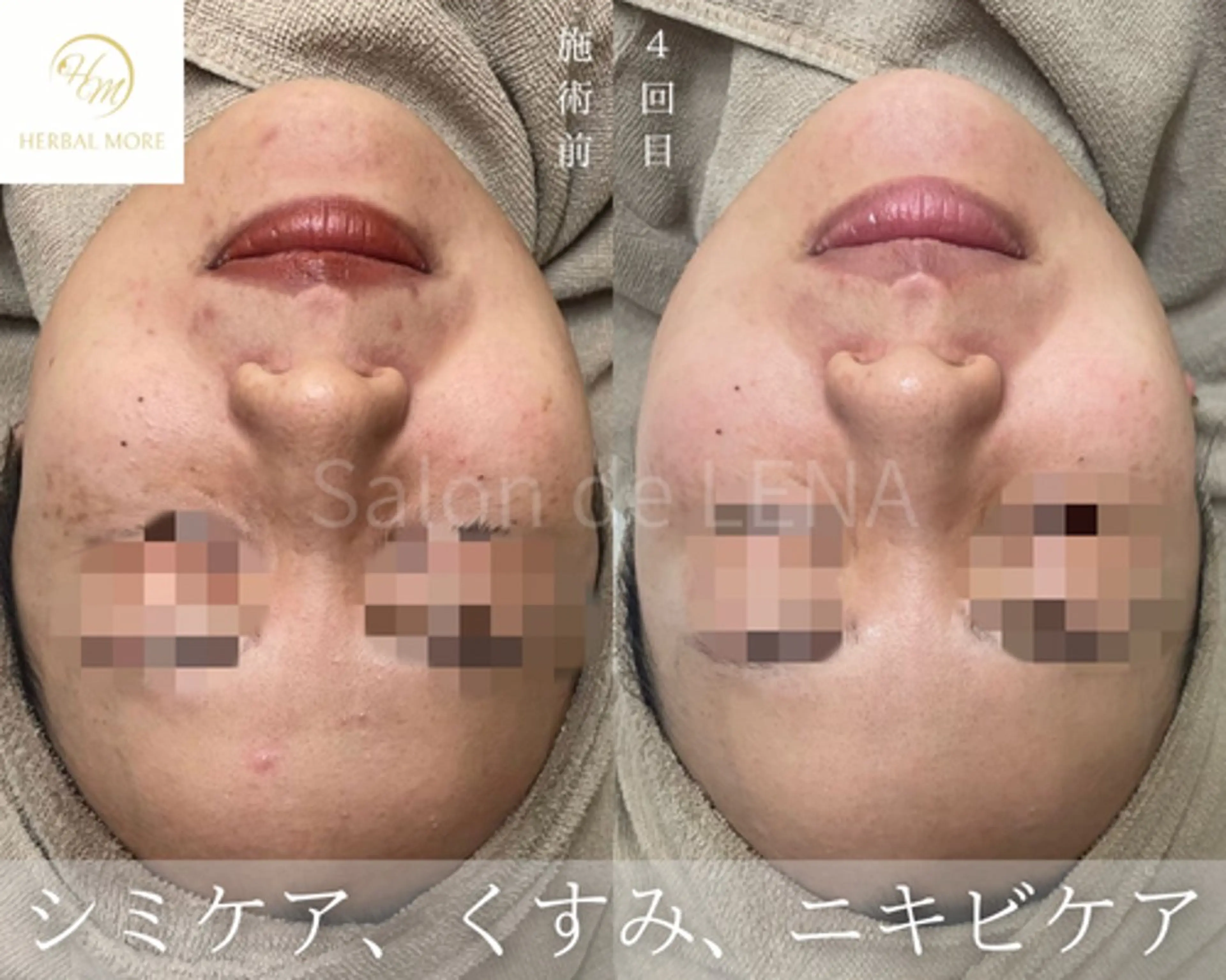 回数券購入経験がある方の都度払い／剥けるハーブピーリング顔or 体から選択の写真