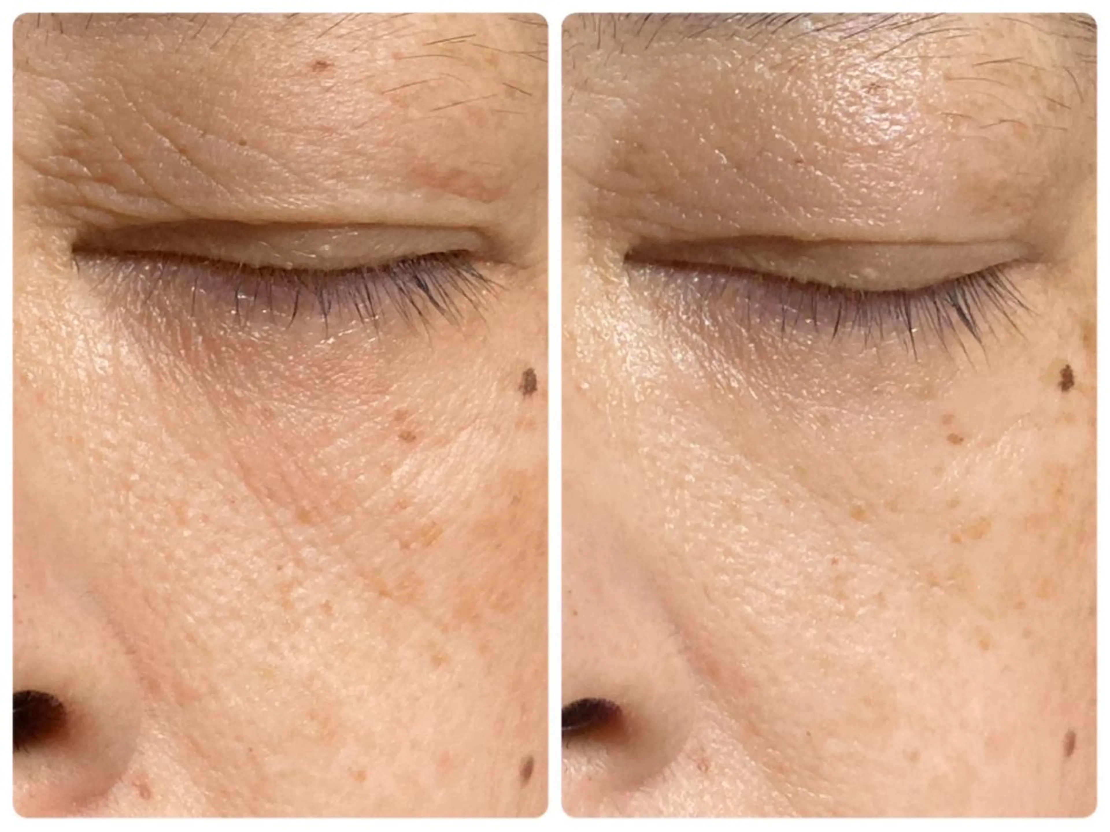 【機器とパックで集中エステ】トラブル改善！の写真