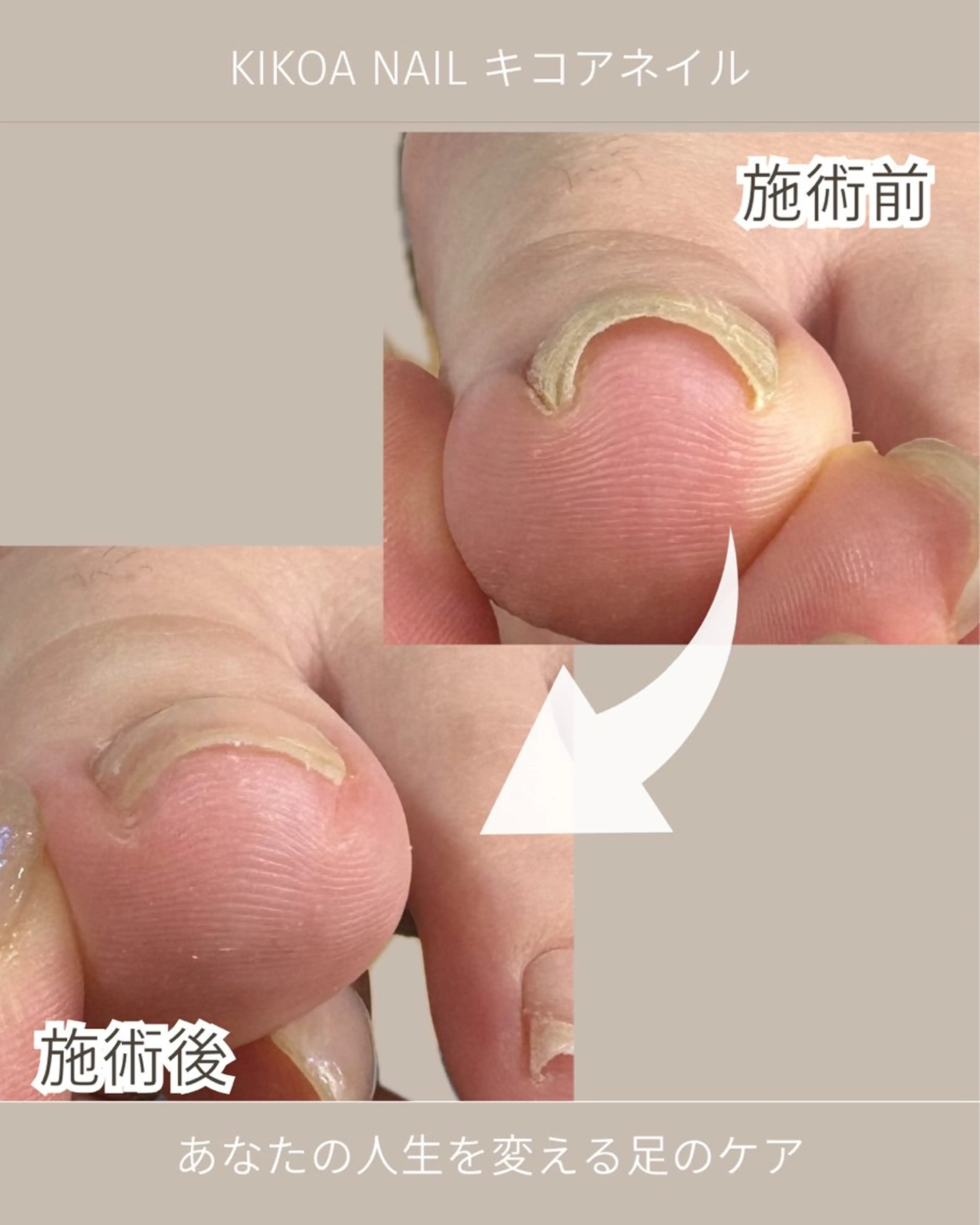 ネイル フットネイル KIKOA NAIL キコアネイルのネイルデザイン