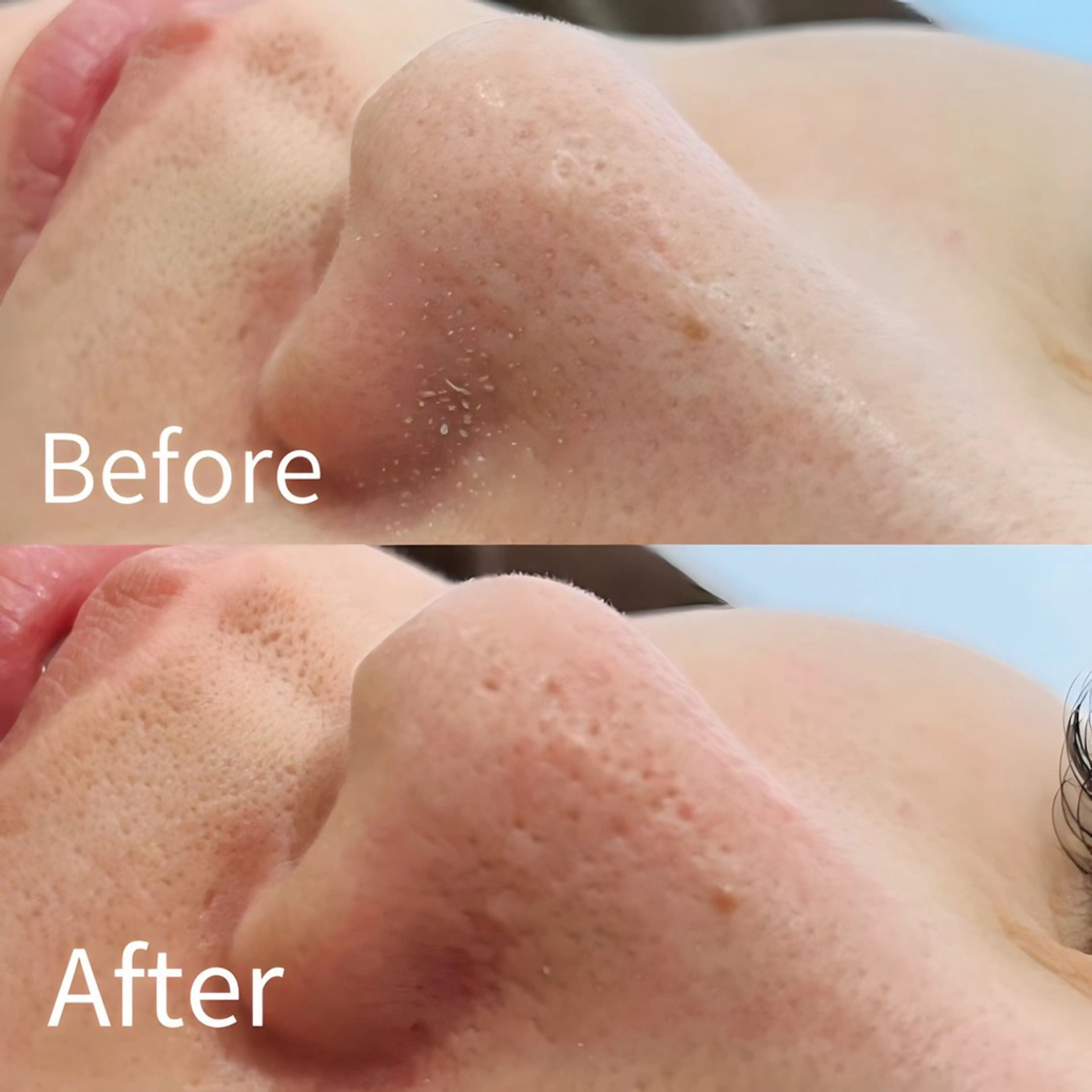 【角栓詰まりに特化】自己ケアでは限界がきた毛穴詰まりを解消！【口コミ割】の写真