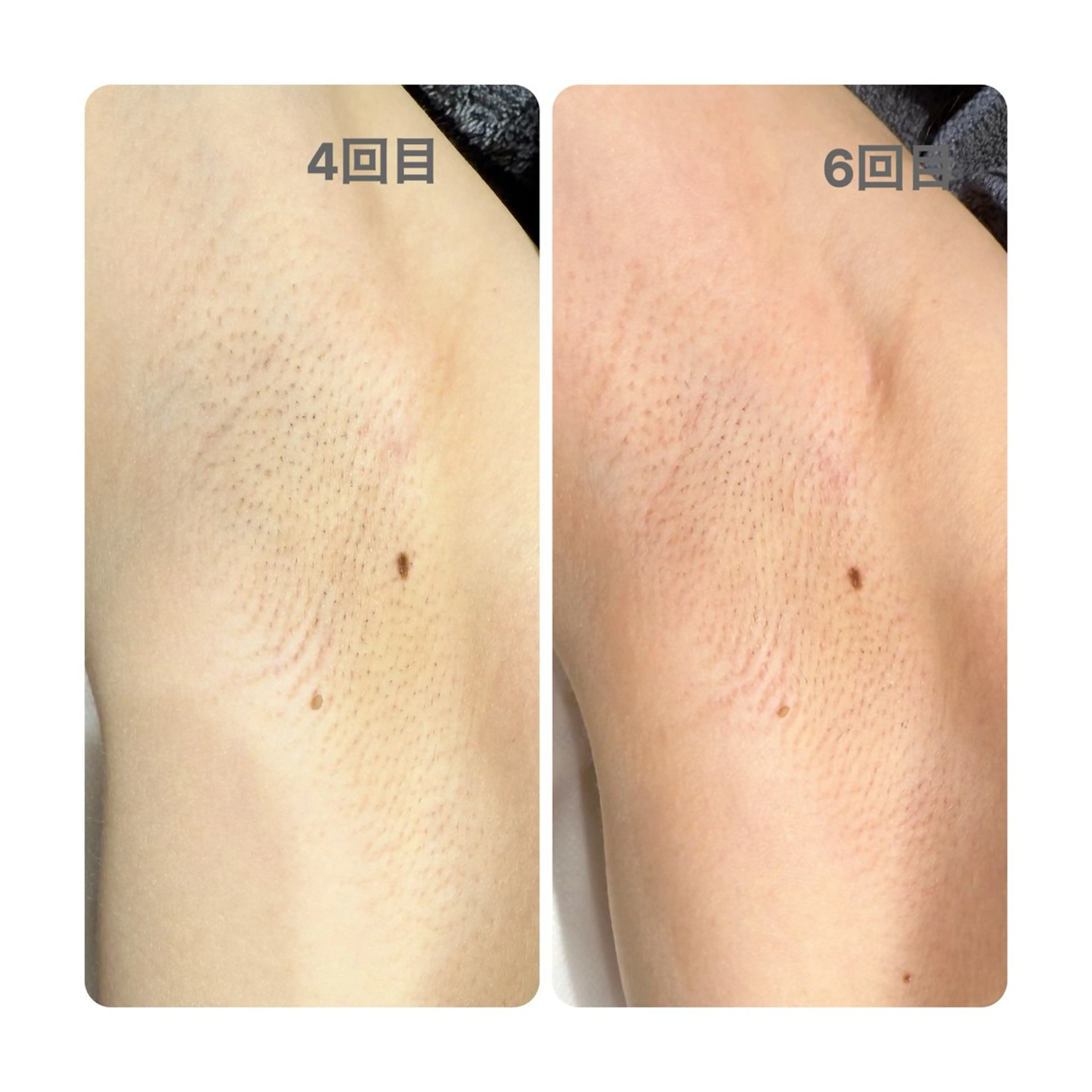 脱毛 greedy東山店 長谷川のエステ・リラクイメージ