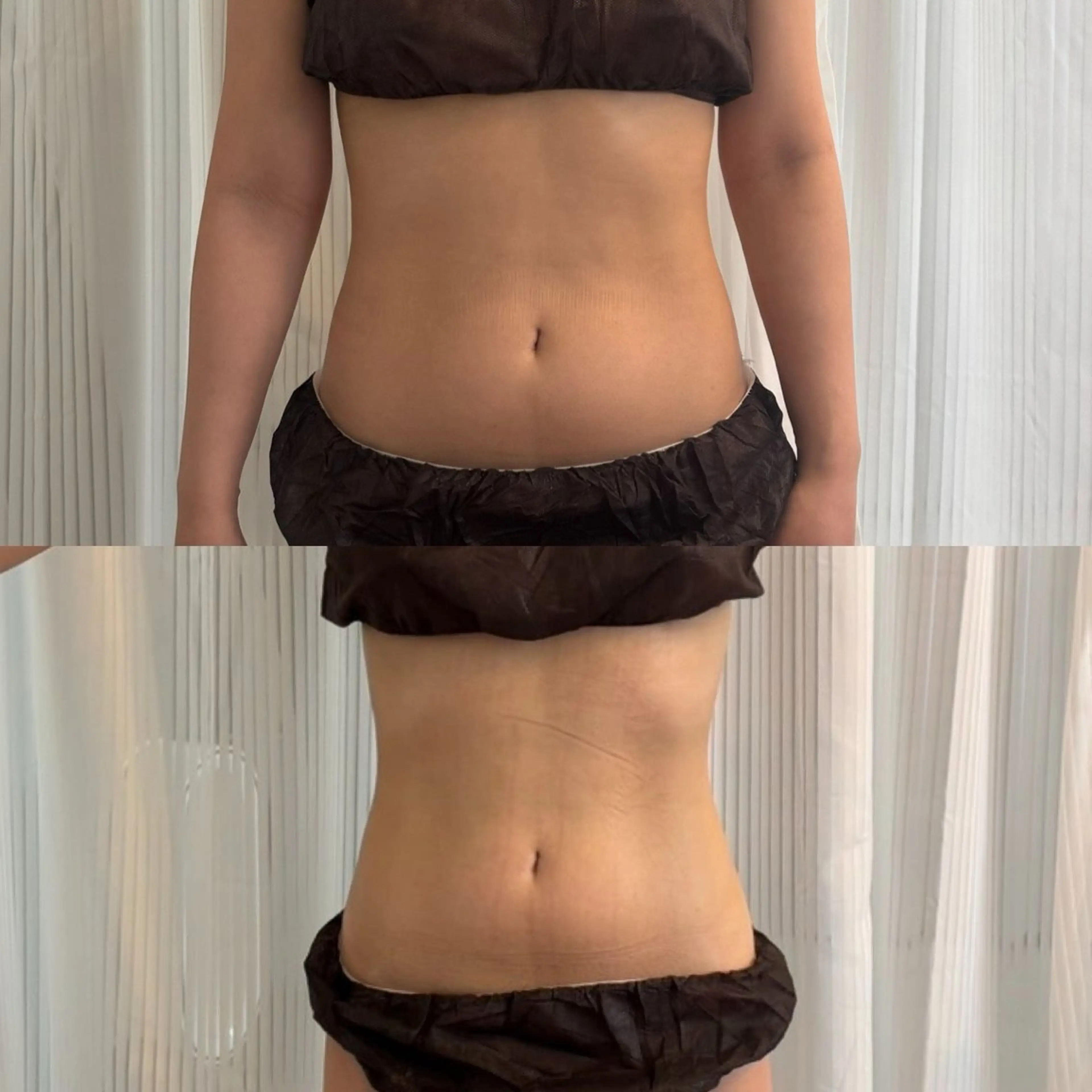 半身痩身　cavi × RF × vacuum × EMS 120min【表参道限定】の写真