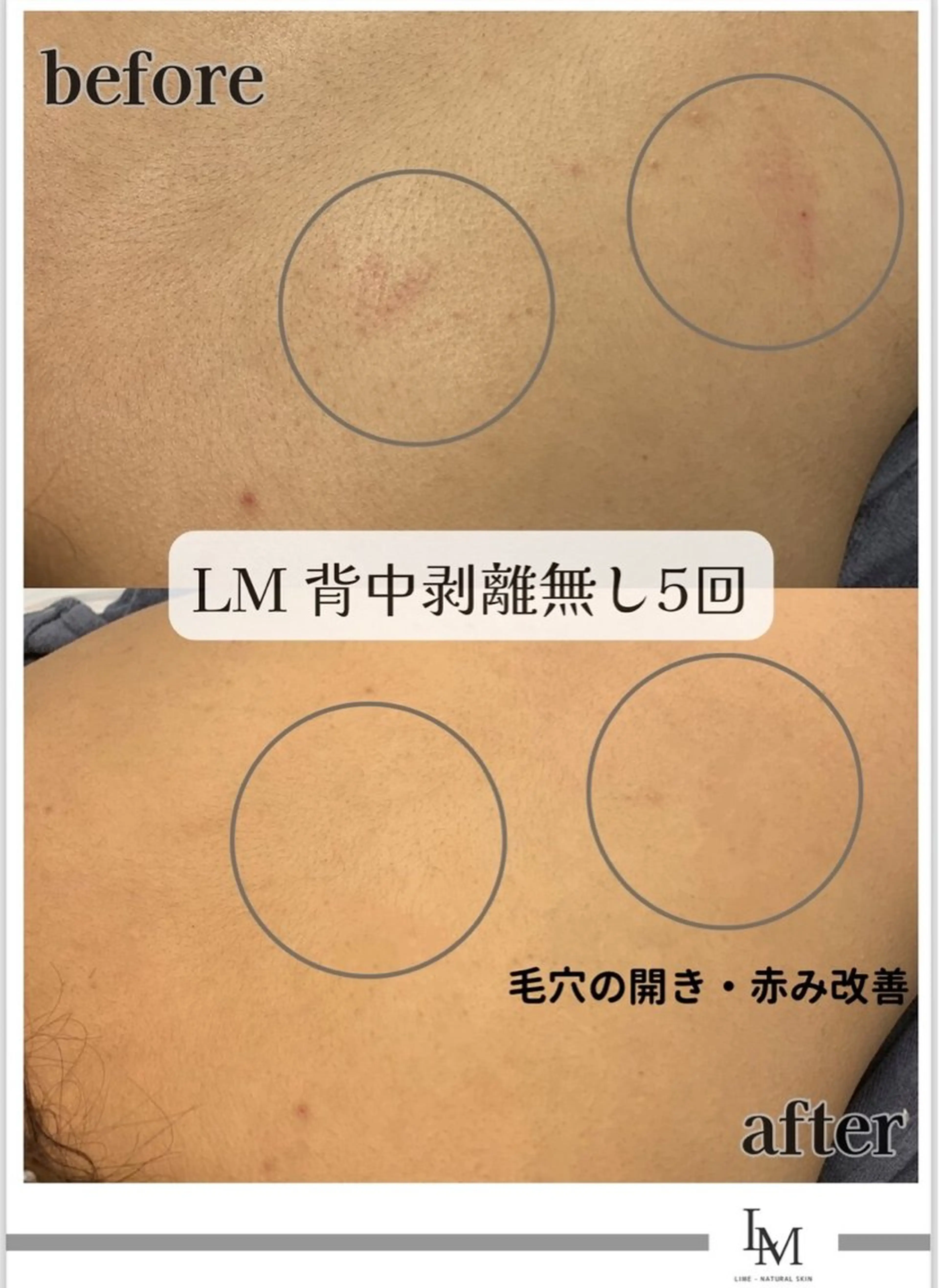 ハーブピーリング LIME池袋東口のエステ・リラクイメージ