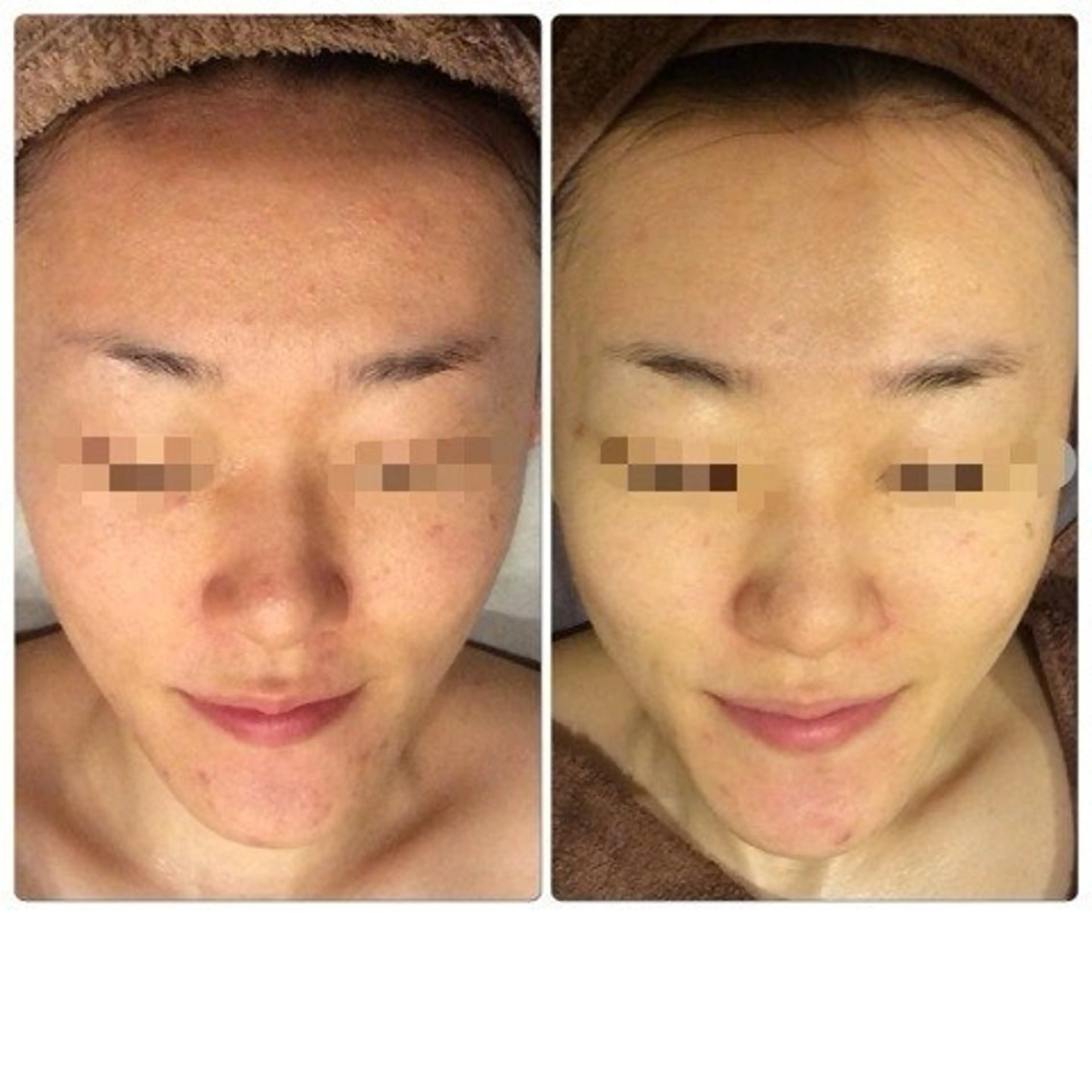 🌿 トゲありハーブピーリング（剥離あり）🌿 敏感肌にも配慮✨自然由来のオーガニックハーブピーリング🌿の写真