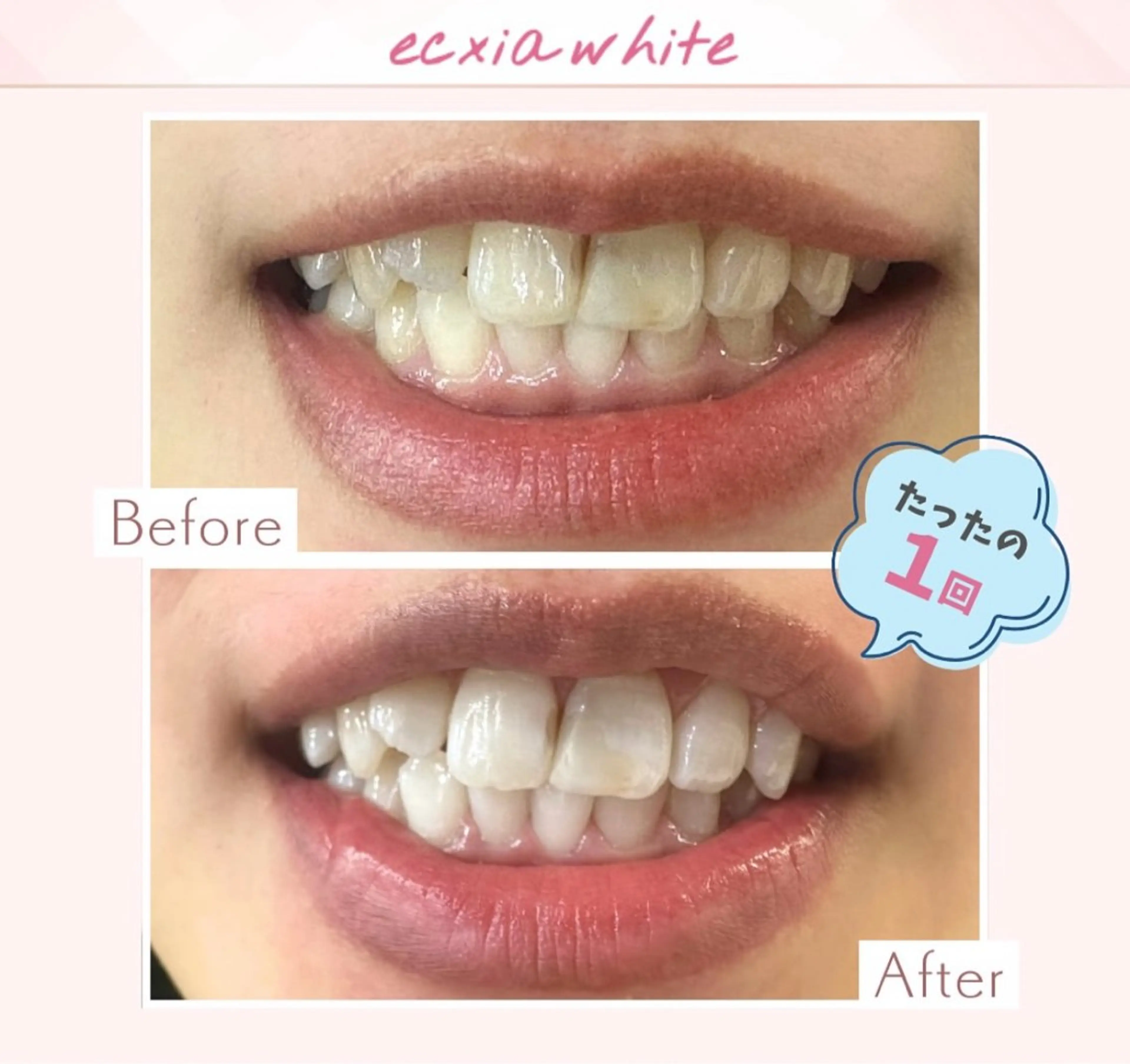 エクシアホワイト調布所属・umi❤︎ ホワイトニングのその他イメージ