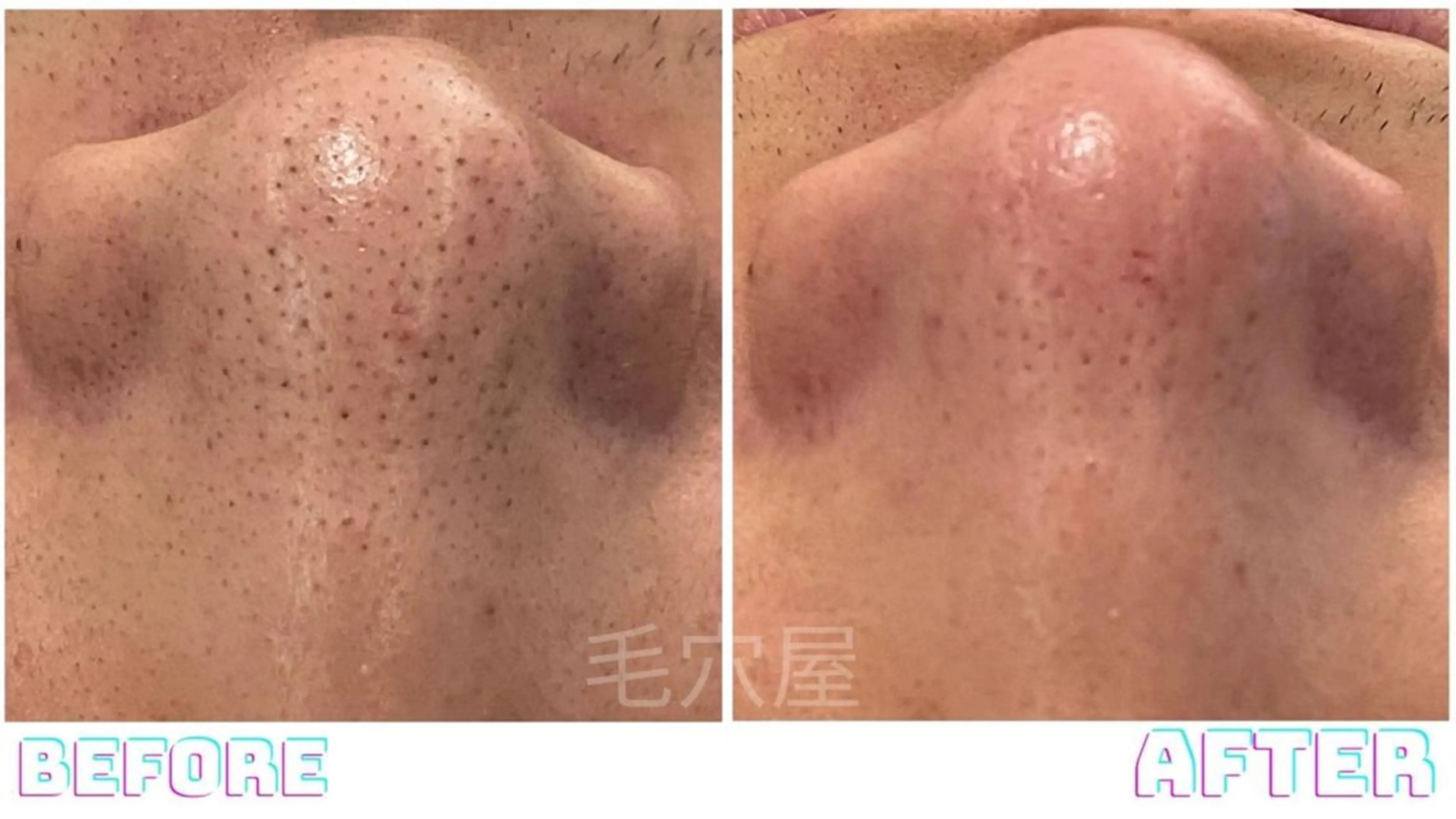 エステ 毛穴/毛穴洗浄専門 エミルカ船橋のエステ・リラクイメージ