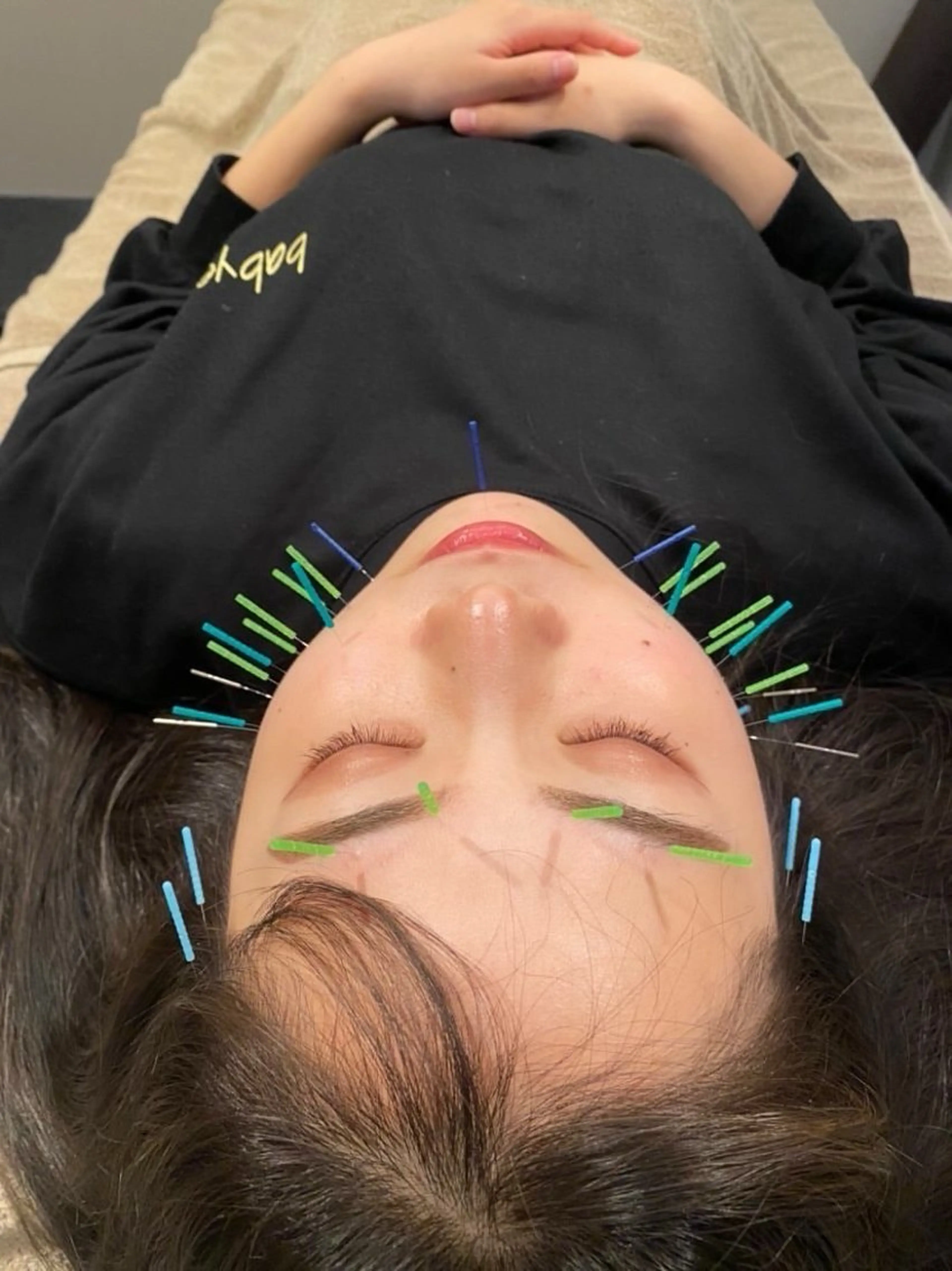 【水曜15時​〜​限定】スペシャル美容鍼　60分¥3,980の写真