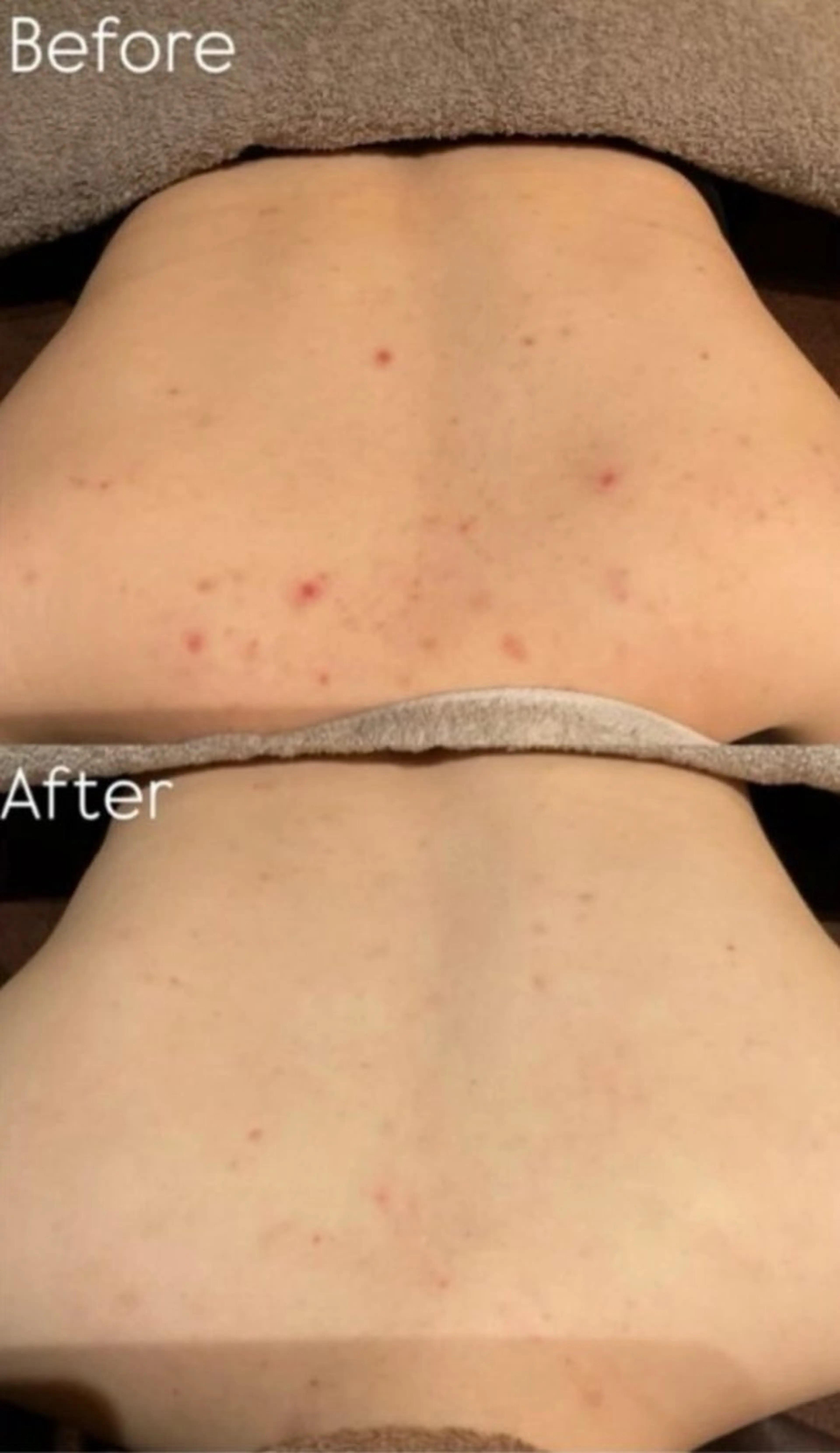 背中フォト/光フォトで背中の吹き出物や毛穴を改善します！の写真