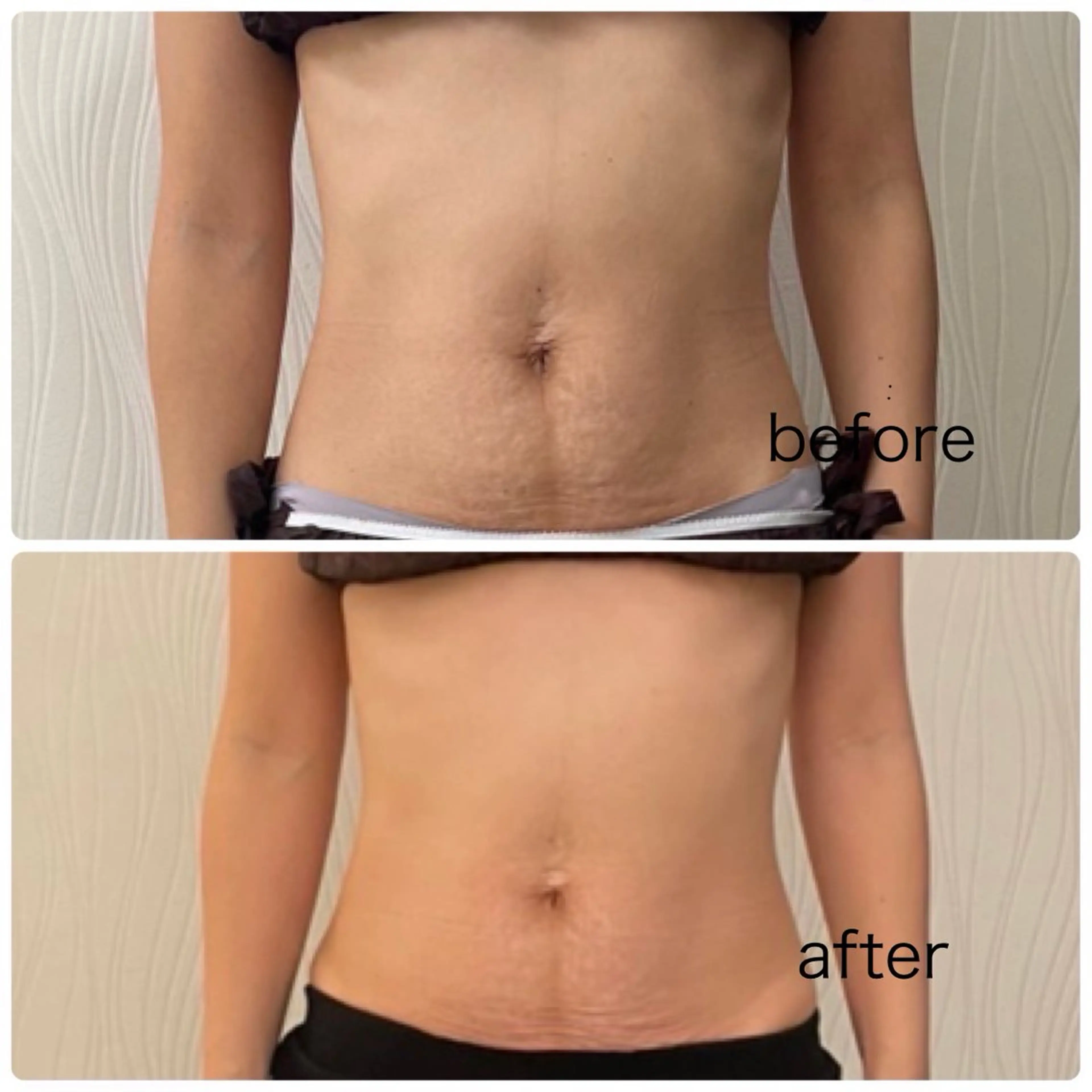 脱毛 次世代痩身 人生最後のダイエットのエステ・リラクイメージ