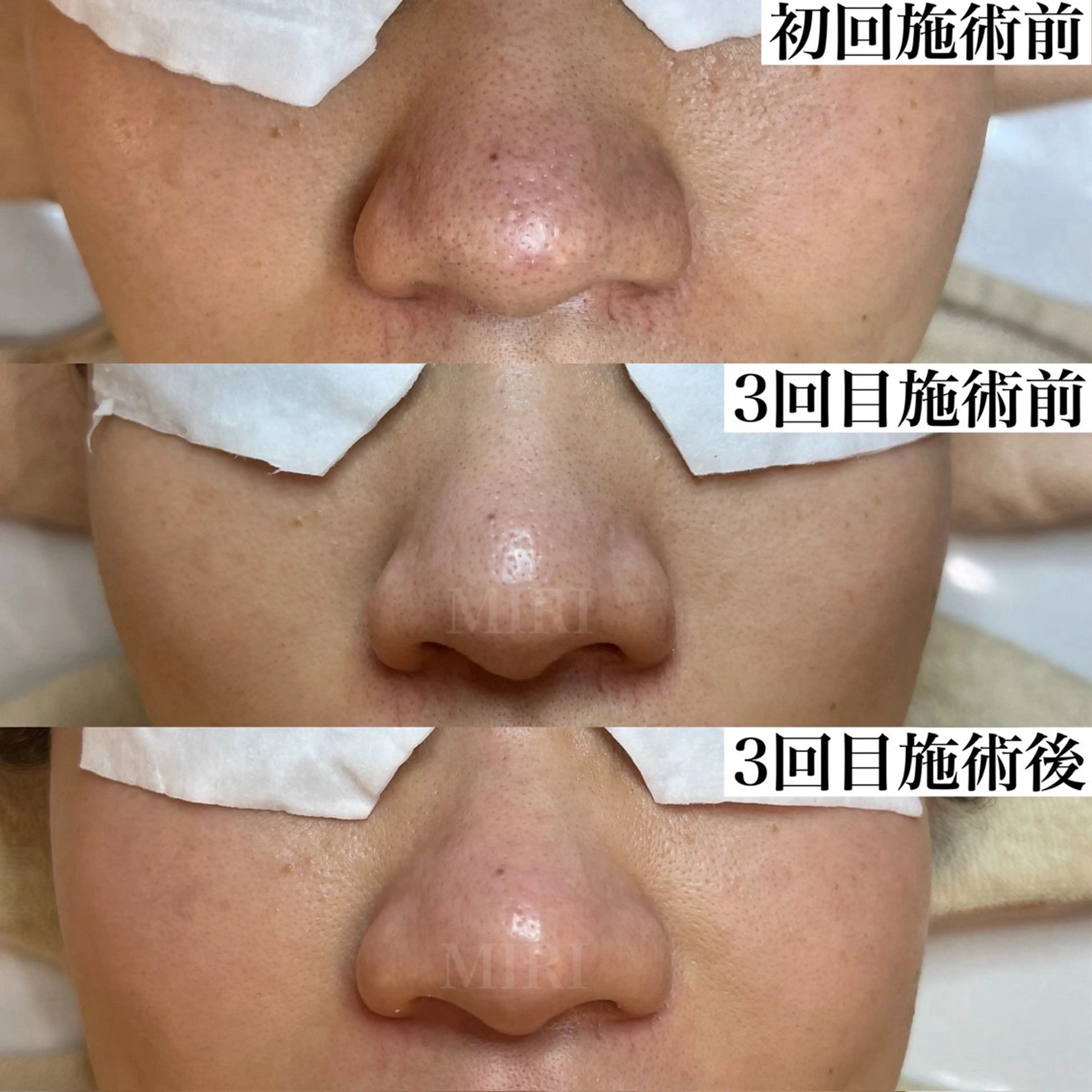 エステ MIRI所属・北堀江/毛穴改善専門 ミリのエステ・リラクイメージ