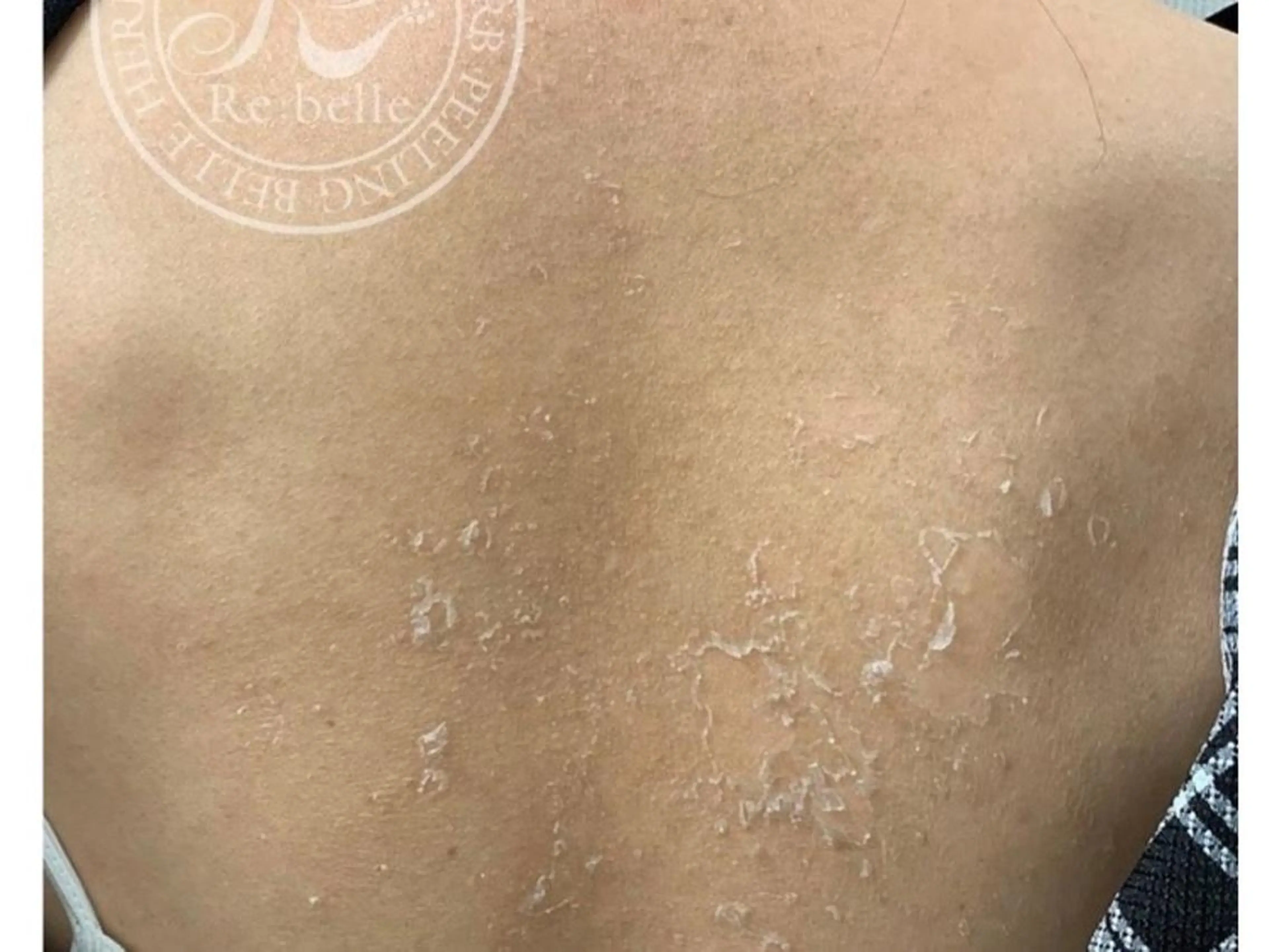 Belsia千歳烏山 ピーリング＆眉毛のエステ・リラクイメージ