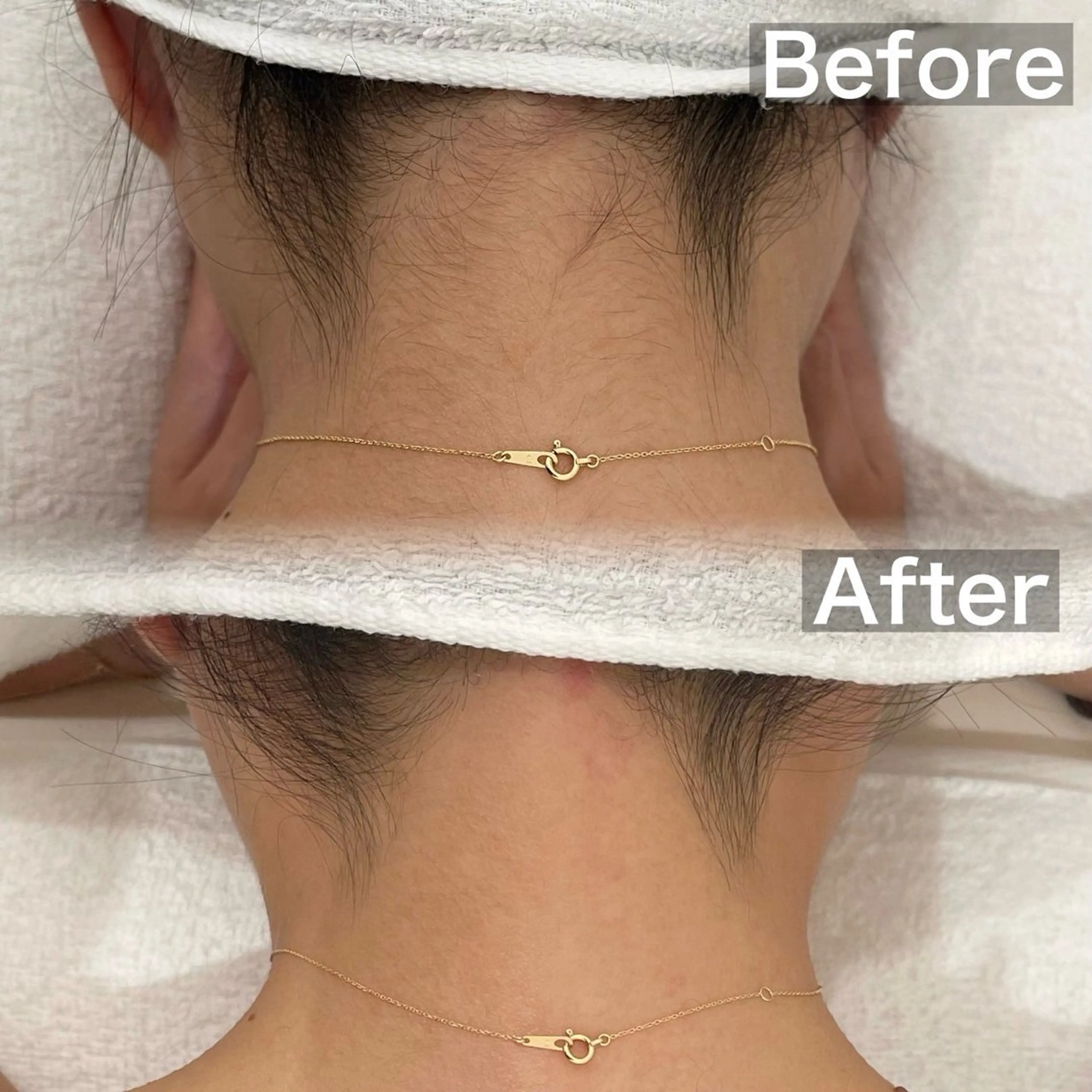 11月限定❣️19･20歳前撮りにオススメ❣️うなじwax✨医療脱毛では取ってくれない所までお好みの形に綺麗スッキリ❣️の写真