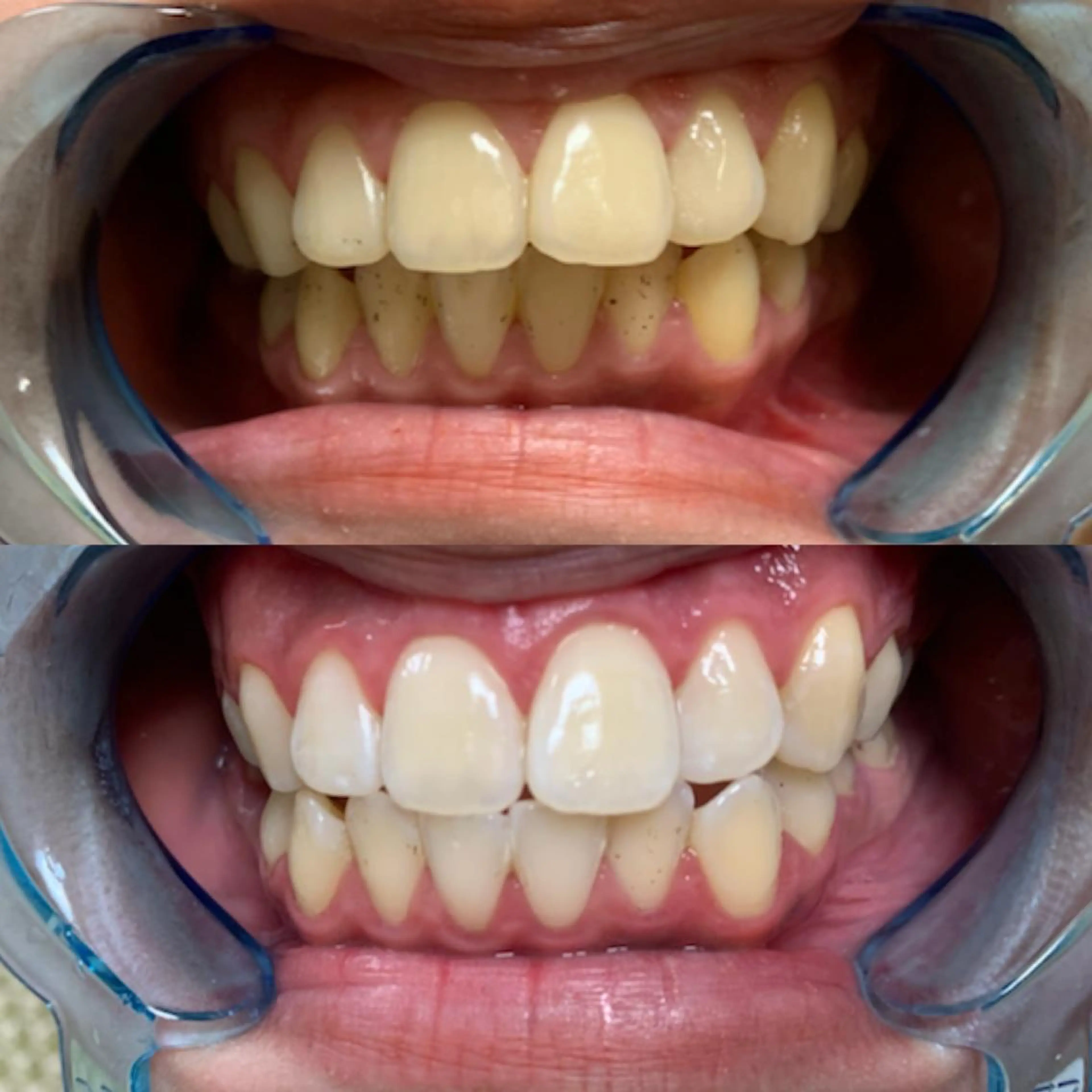 ホワイトニング🦷✨15分✖︎3回の写真