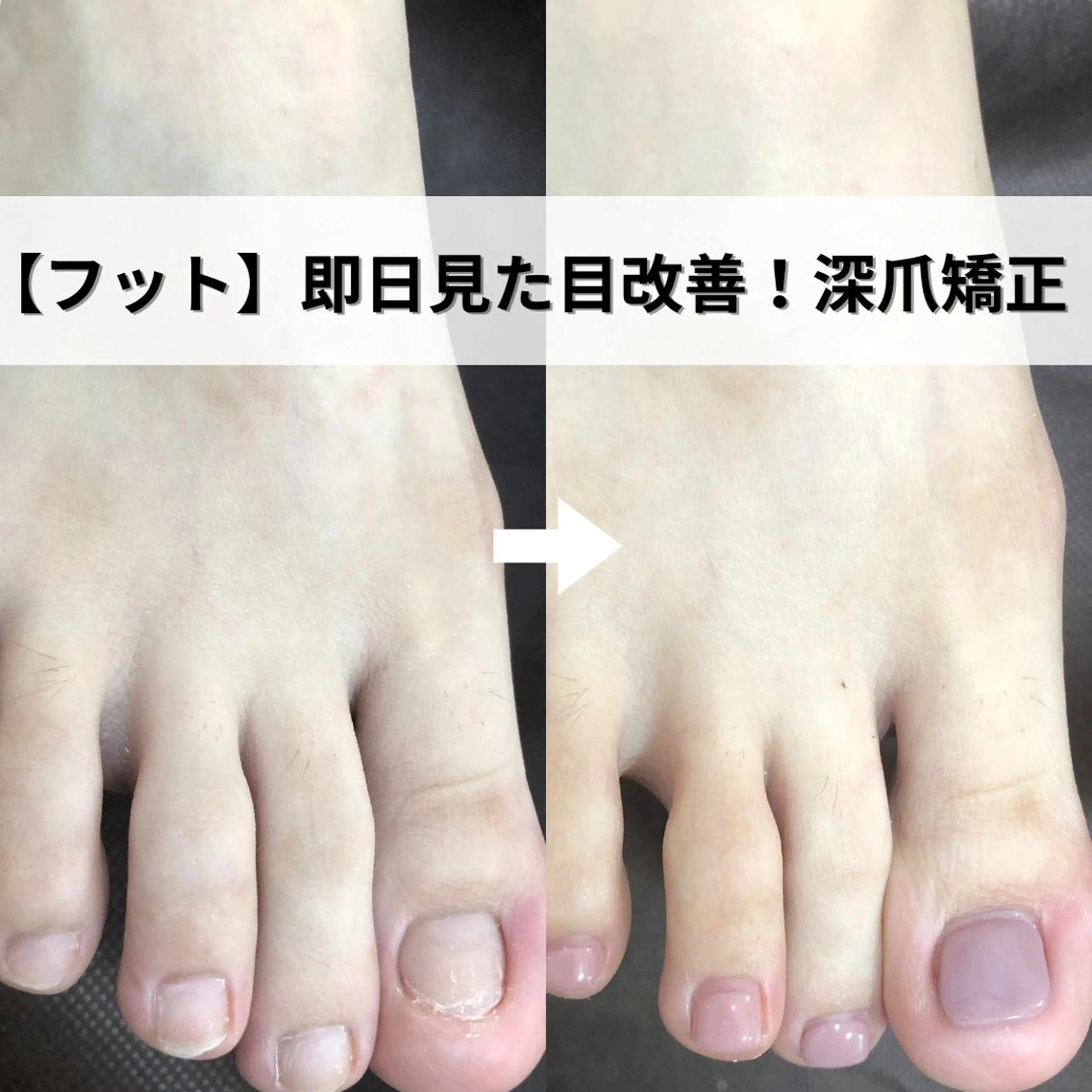 深爪矯正専門ネイルサロンエルナ所属・深爪矯正専門 ネイルサロンエルナのネイルデザイン