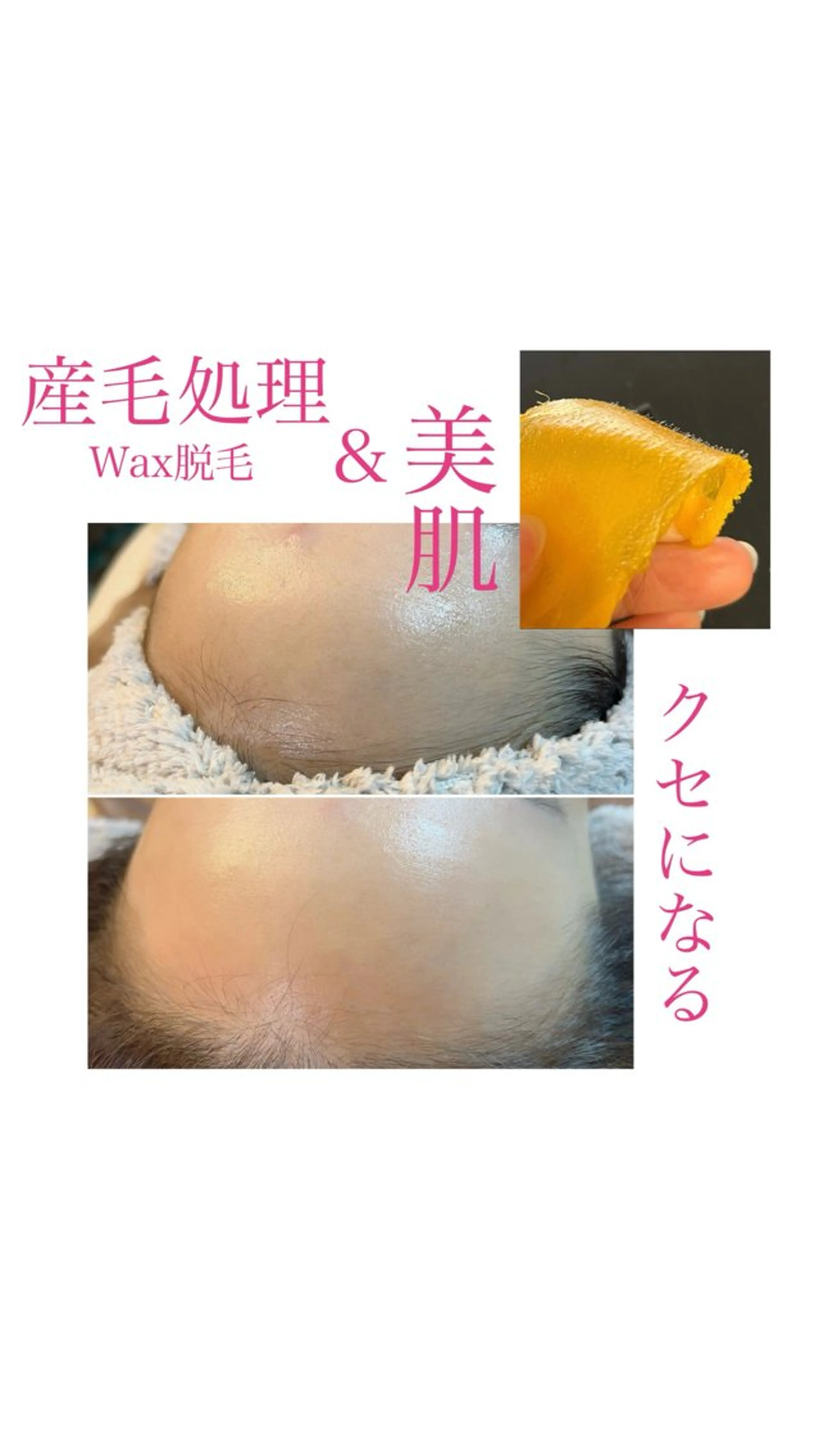 【最強✊顔のムダ毛処理】毛やポツポツ汚れや毛穴詰まりを根こそぎWAXで除去！輝くツルツル感動の肌触り👼の写真