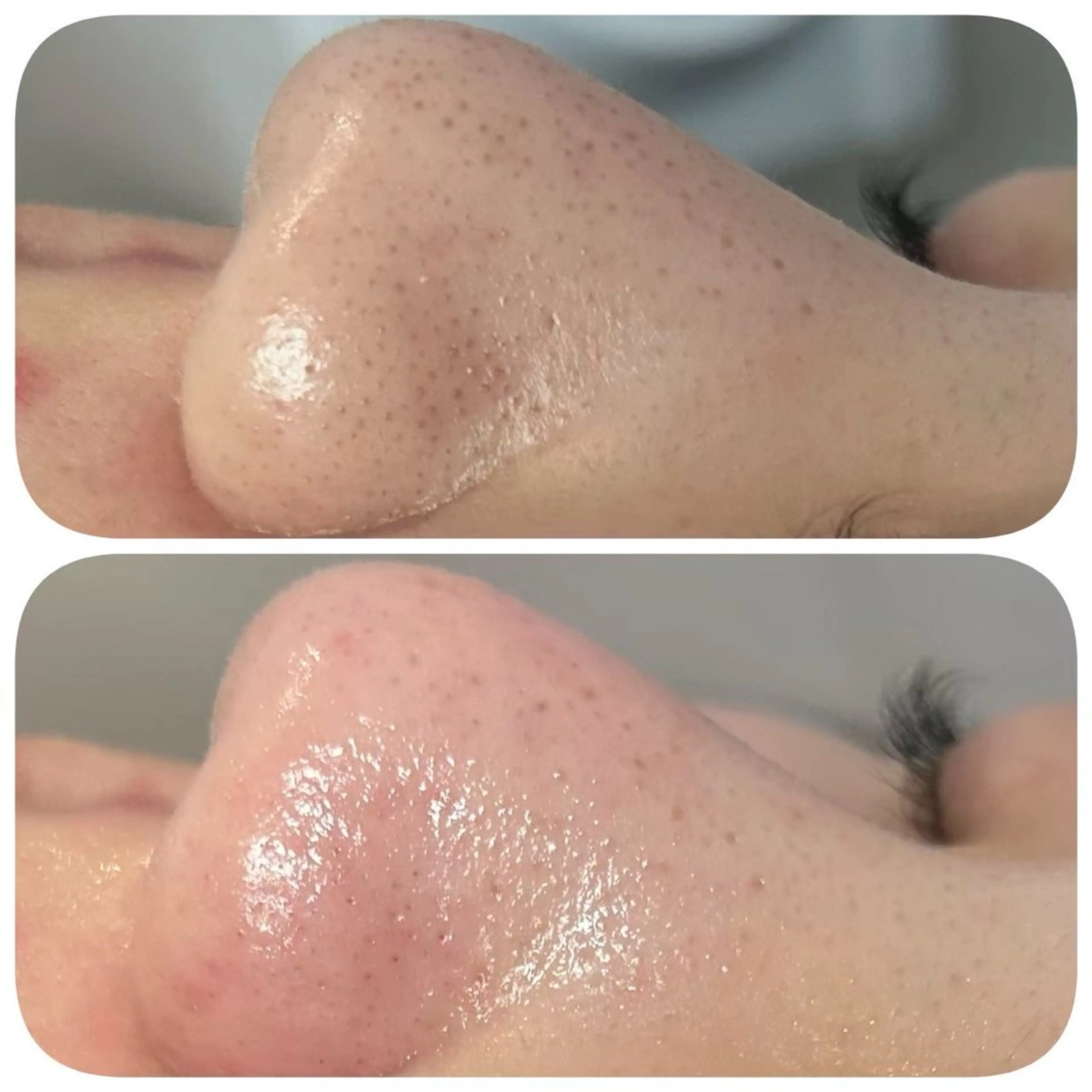 毛穴エクストラクション👃🏻✨の写真