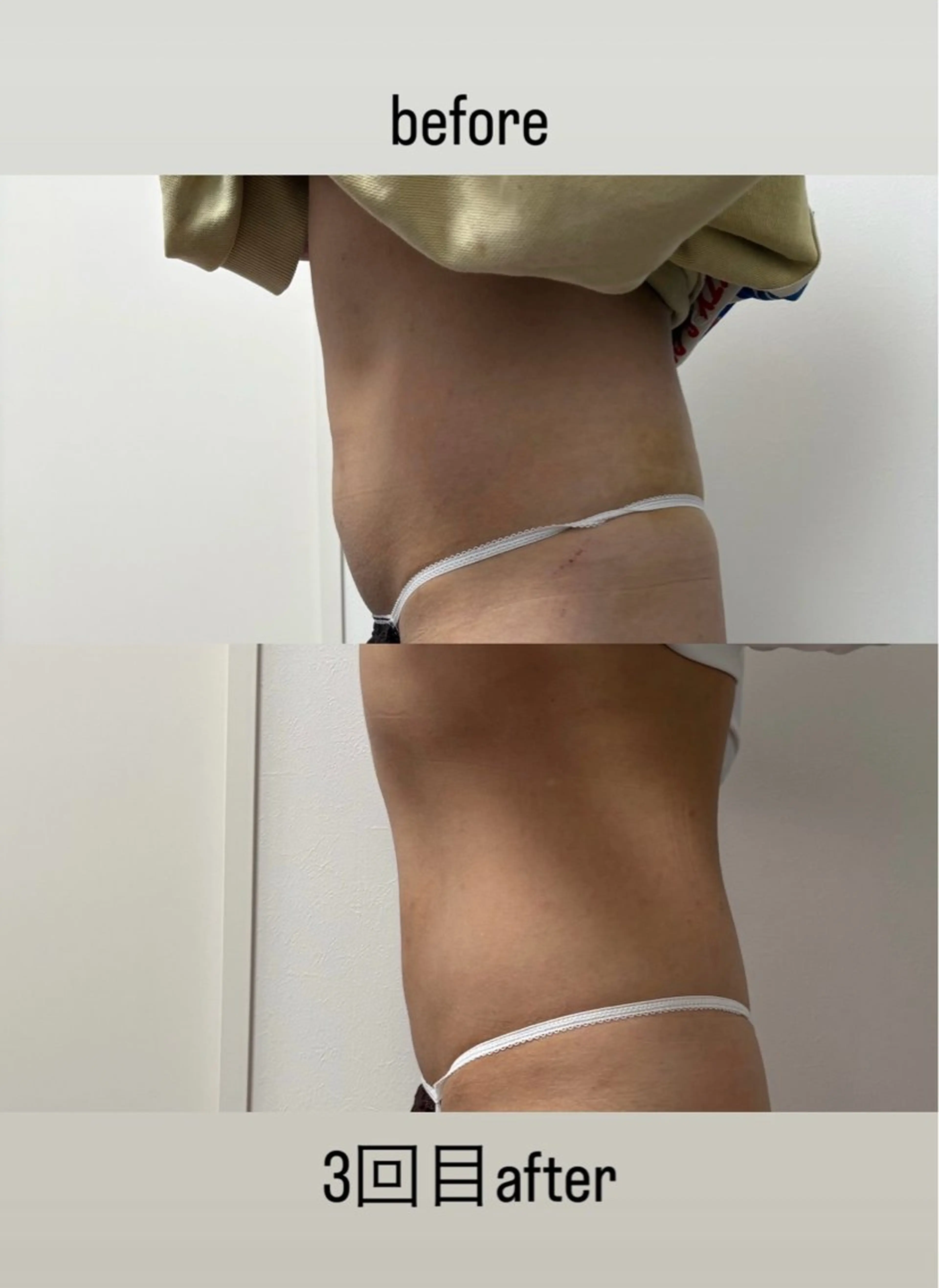 エステ Miiju.所属・Miiju. 石巻市 脂肪冷却  鈴木のエステ・リラクイメージ