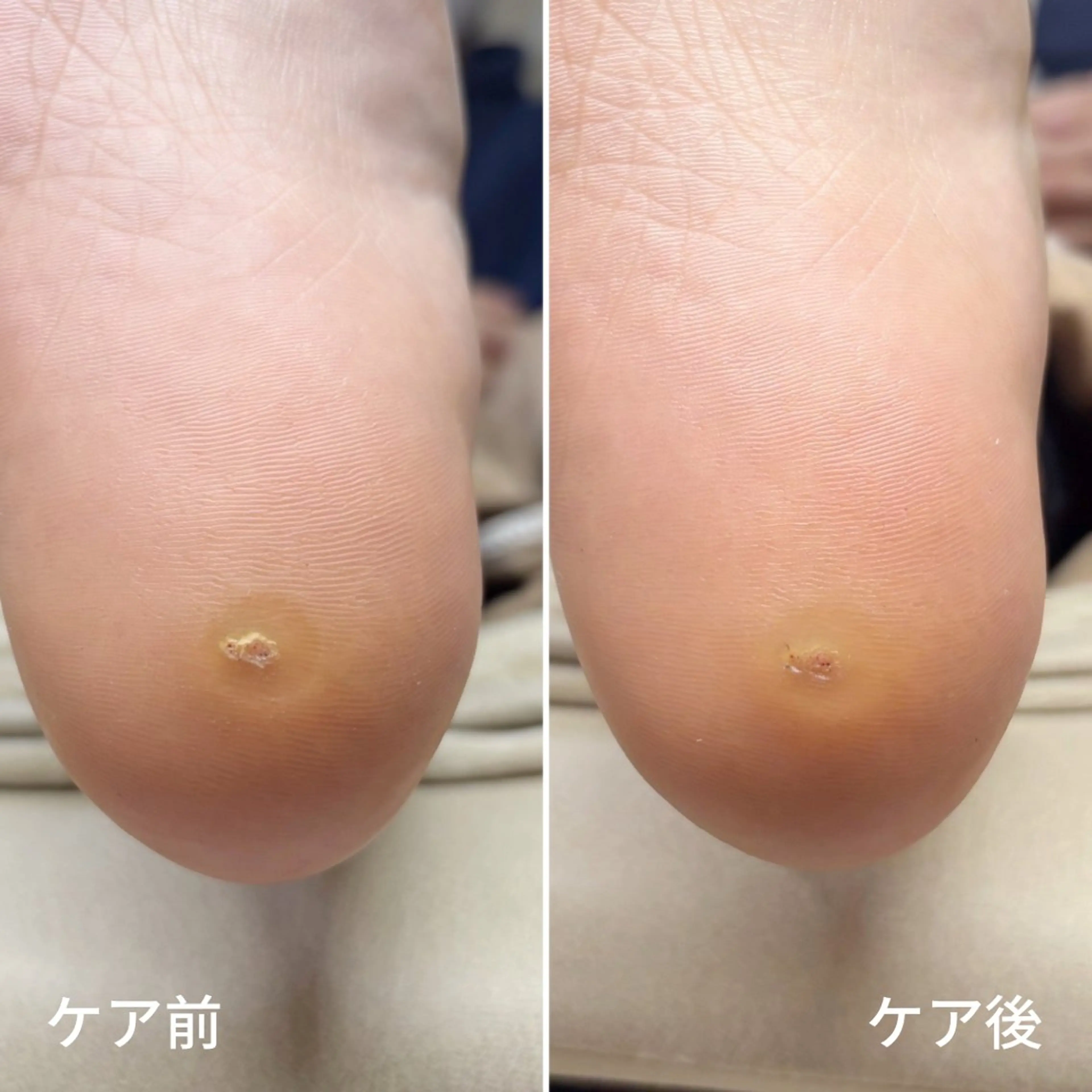 ネイル フットネイル フットネイル 深爪・巻き爪 専門サンセリテのネイルデザイン