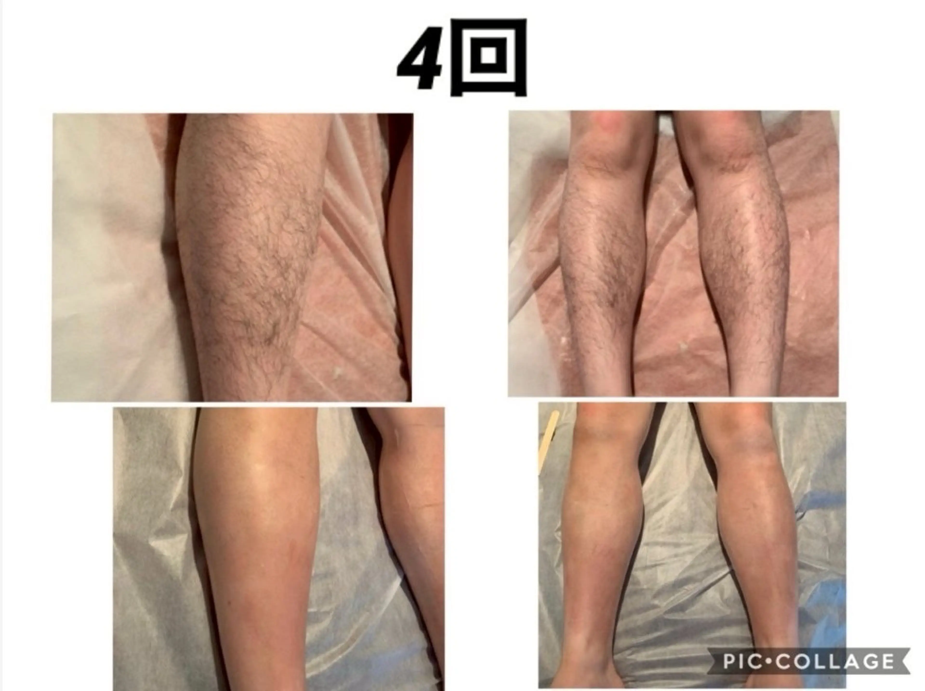 背中上下or両足　IPL半永久脱毛　近隣最安値⭐️エステ脱毛の最高峰をご体感ください♪の写真