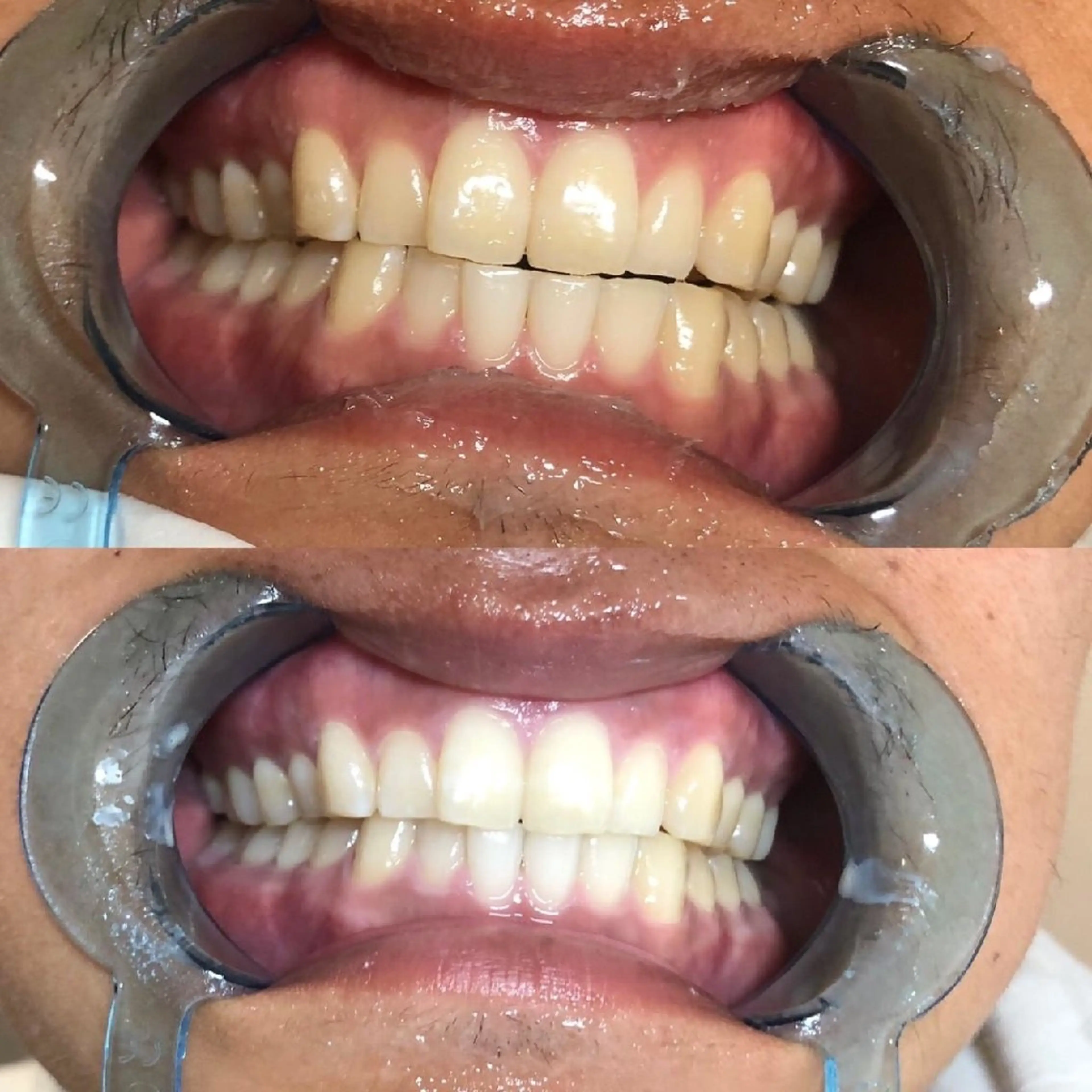 🦷🍀ミニモ限定10名様まで🦷🍀2来店合計80分￥20000円→￥12000円⭕️🌈真っ白コース🌈の写真