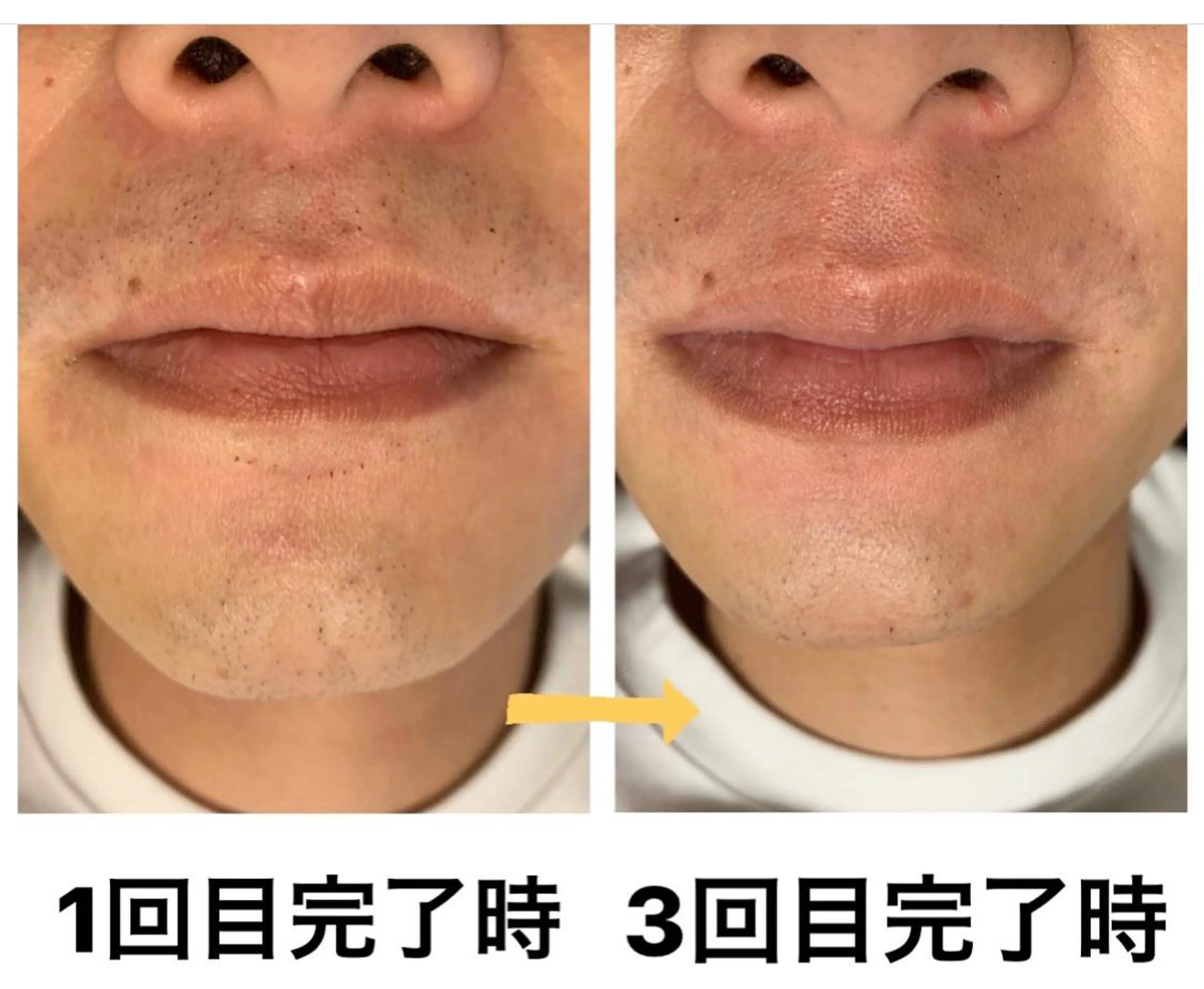 脱毛 メンズ脱毛サロン Le falcoのエステ・リラクイメージ