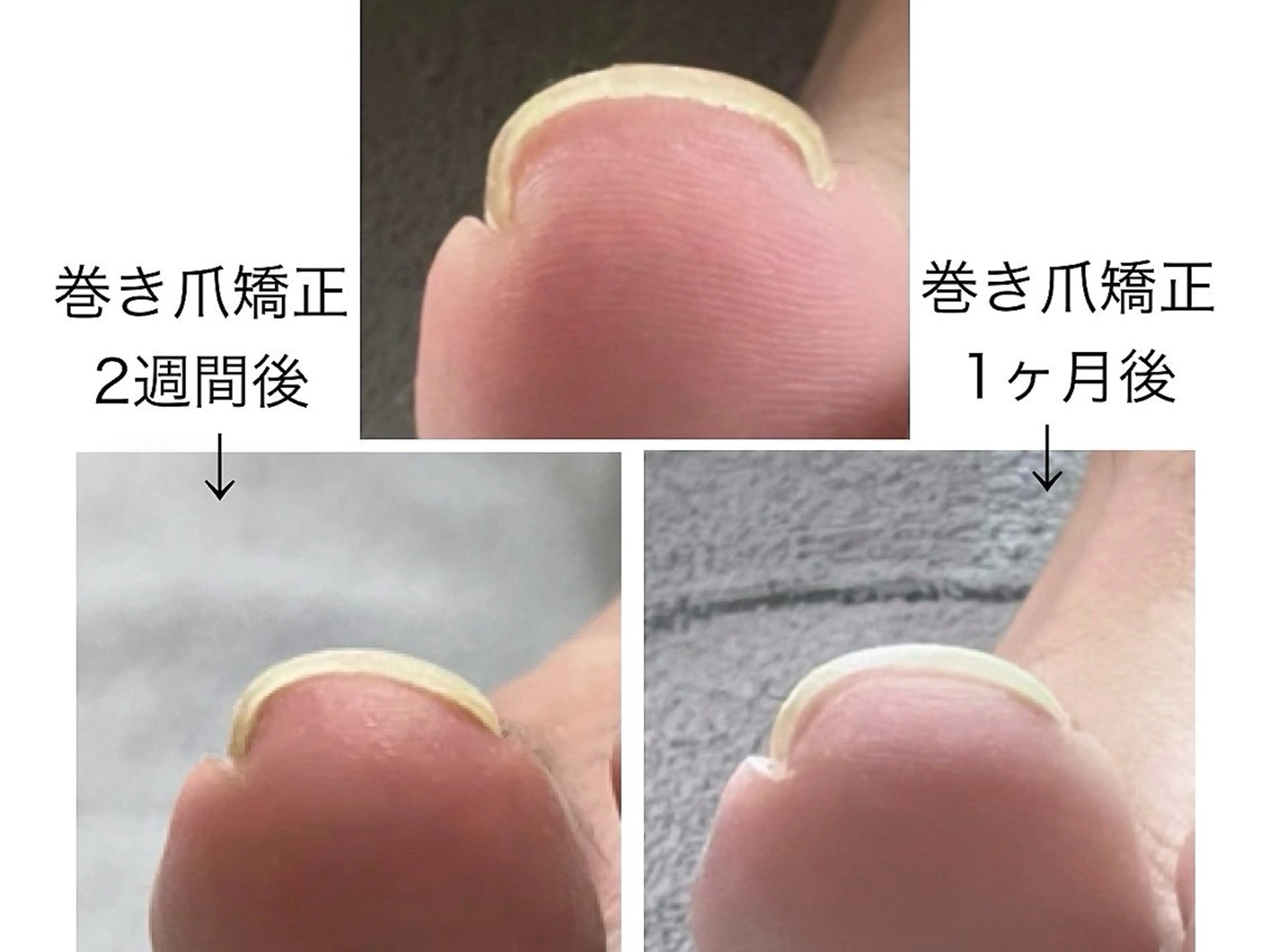 ✨ジェルタイプ✨👣巻き爪矯正２本（両親指）men'sもokの写真