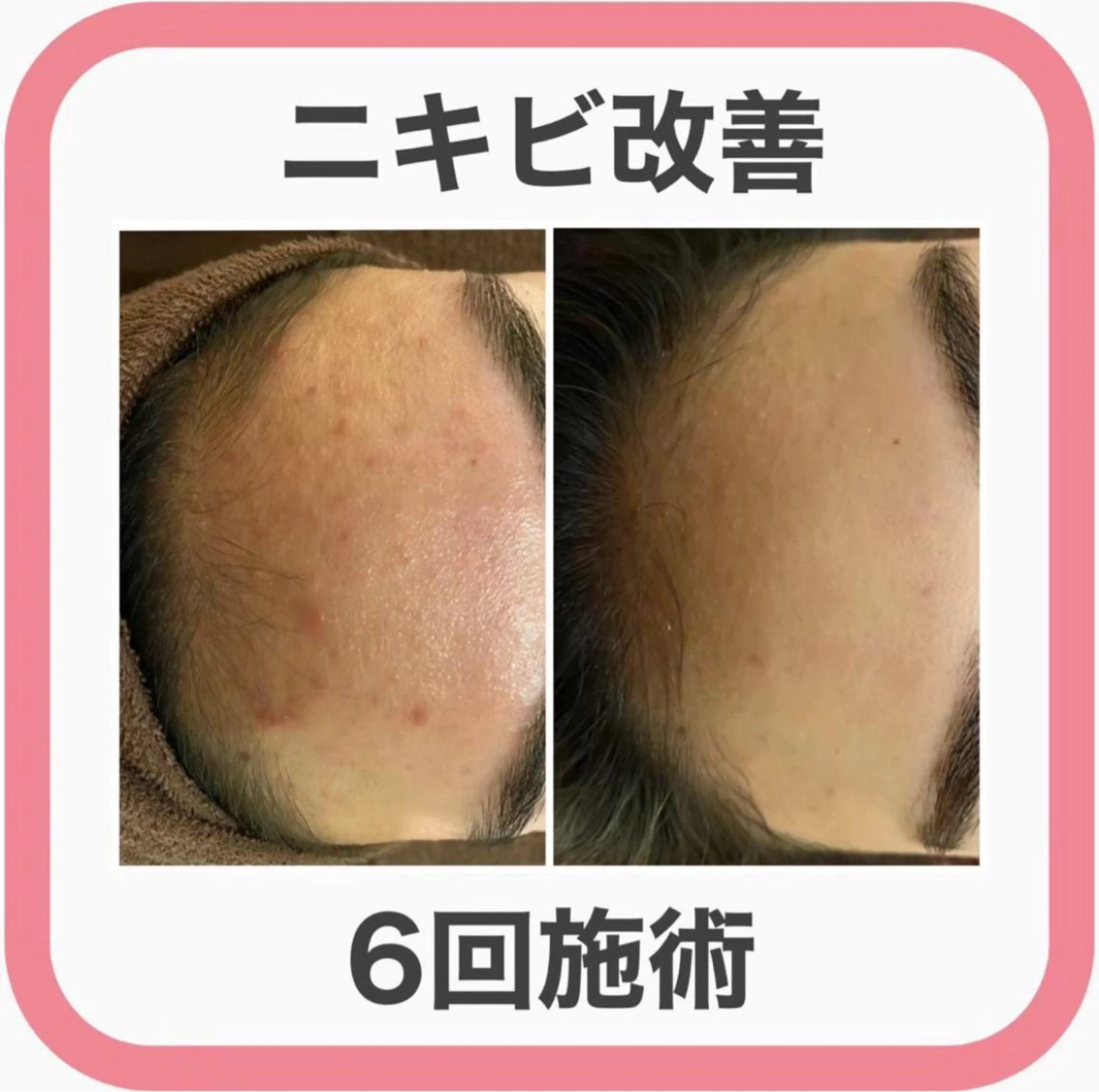 学生ニキビ改善🍀 優しい肌質改善のエステ・リラクイメージ