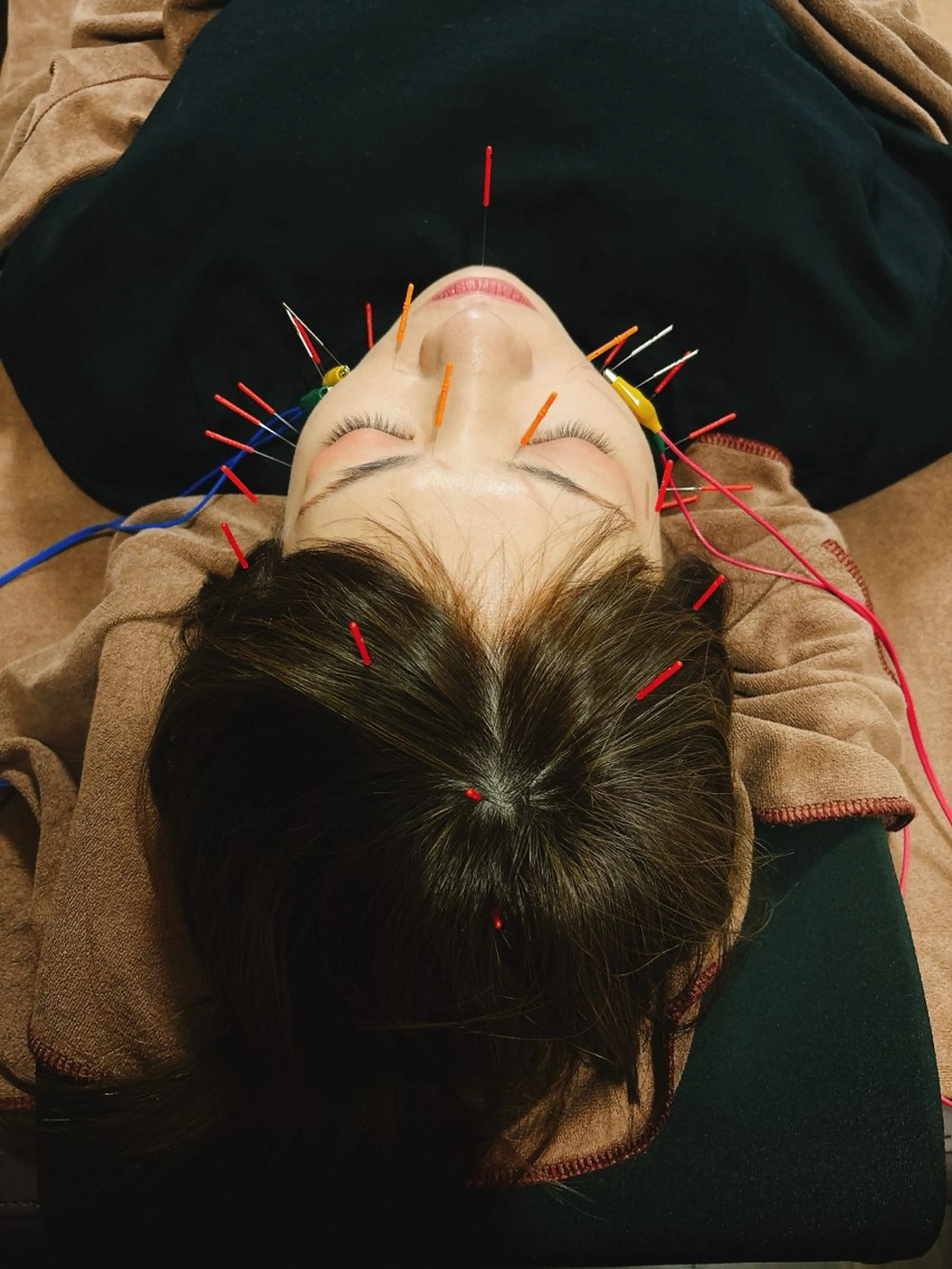 💆‍♀️美容鍼➕リンパマッサージ➕首肩マッサージ✨の写真