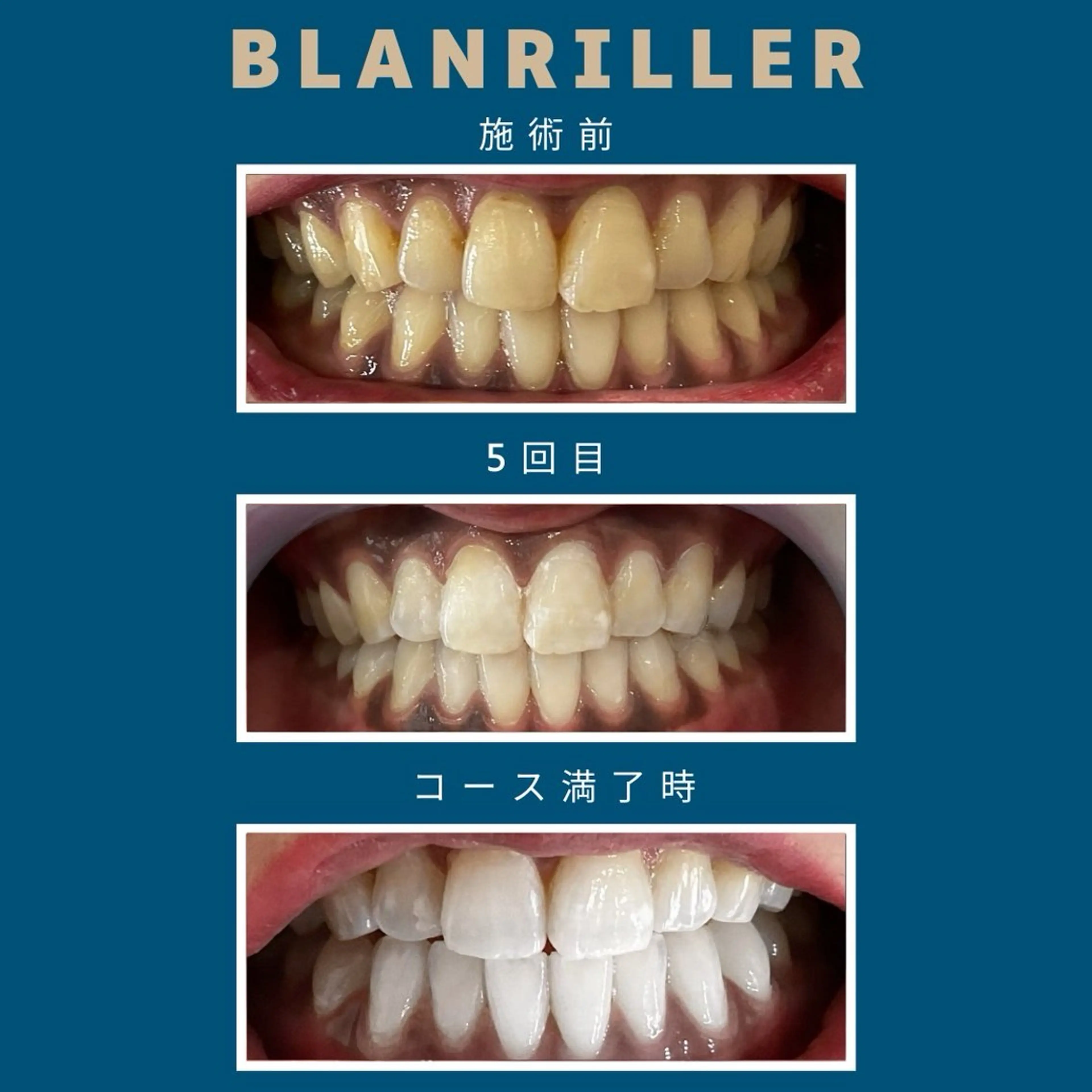 【6ヶ月通い放題】当店人気No.1✨高濃度セルフホワイトニング 月額9000円❤安心・安全どこよりも低価格で高品質🎶の写真