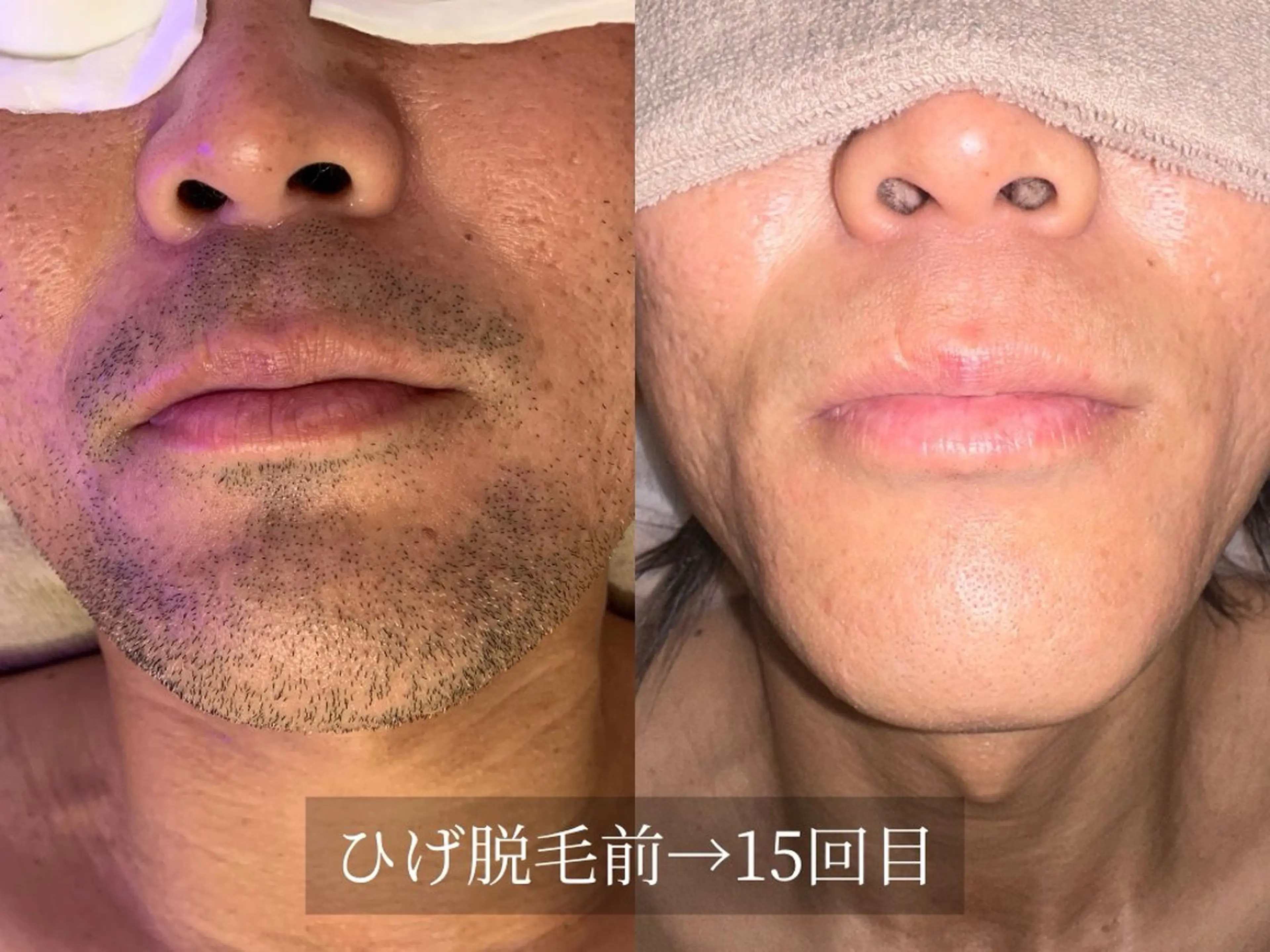 【男性】ひげ脱毛(目の下​〜​首)照射後ケア込の写真