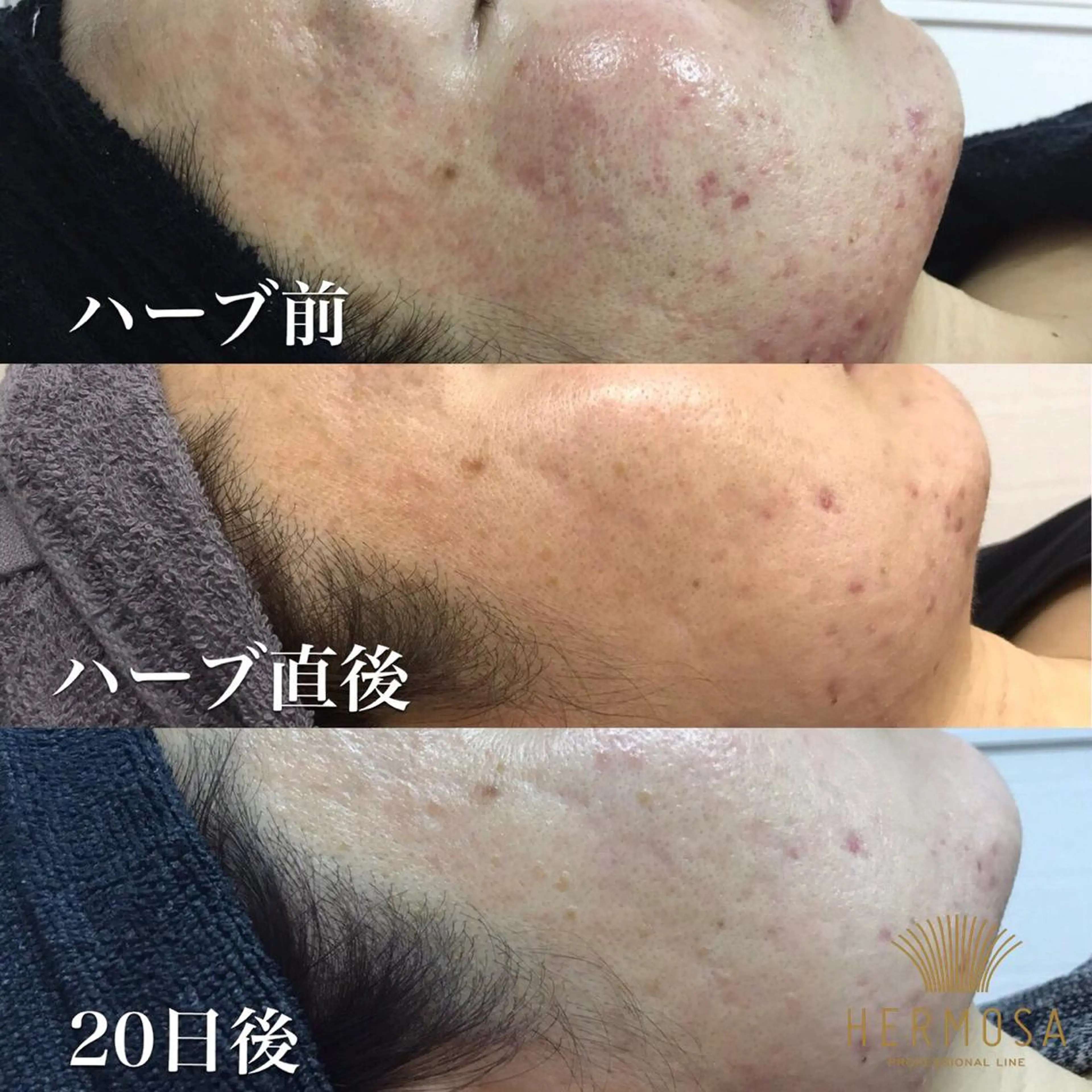 【お試しハーブピーリング】繰り返すニキビ集中ケア　70分の写真