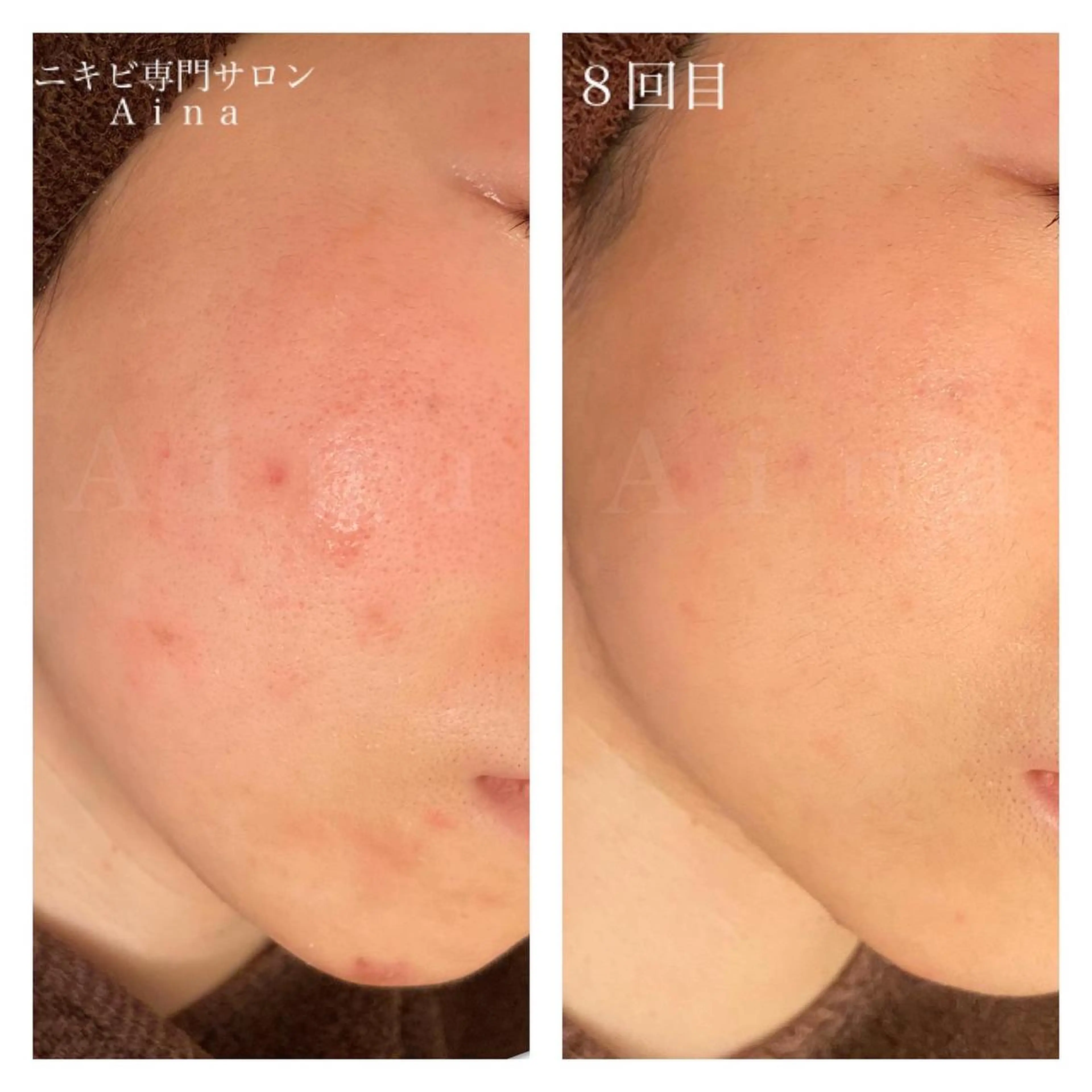 ロング カラー パーマ ヘアアレンジ メンズ キッズ ネイル マツエク・マツパ 学生（メンズ向け） 学生 ニキビ跡専門サロン Ａｉｎａのエステ・リラクイメージ