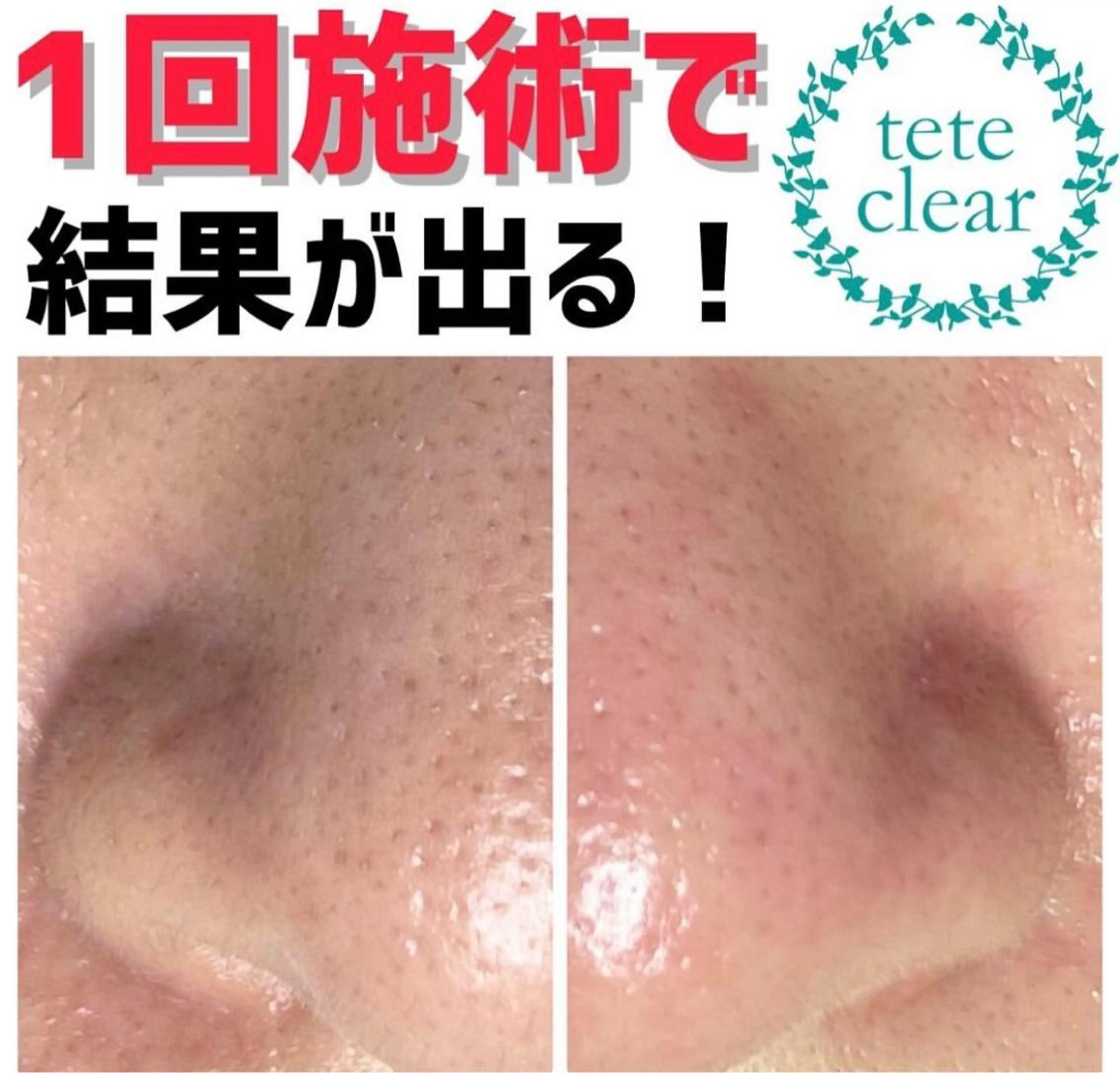 エステ Reine BeautySalon所属・毛穴/シミ肝斑/脱毛 横山梨里のエステ・リラクイメージ