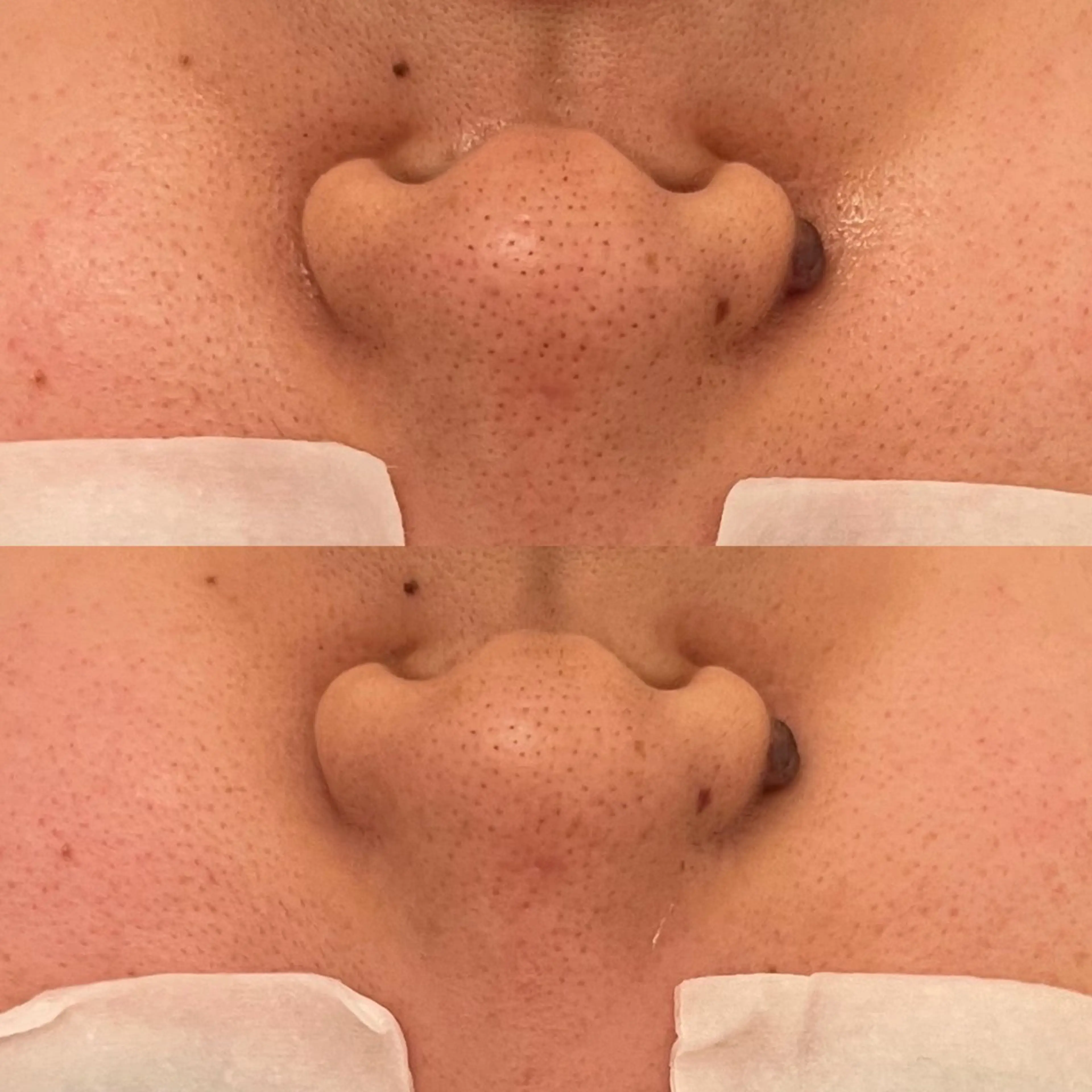 《本気の毛穴改善》ツヤ肌No.1 パーフェクトハイドラスパークコース/ 全ての毛穴トラブルに◎美容液導入マッサージ付きの写真