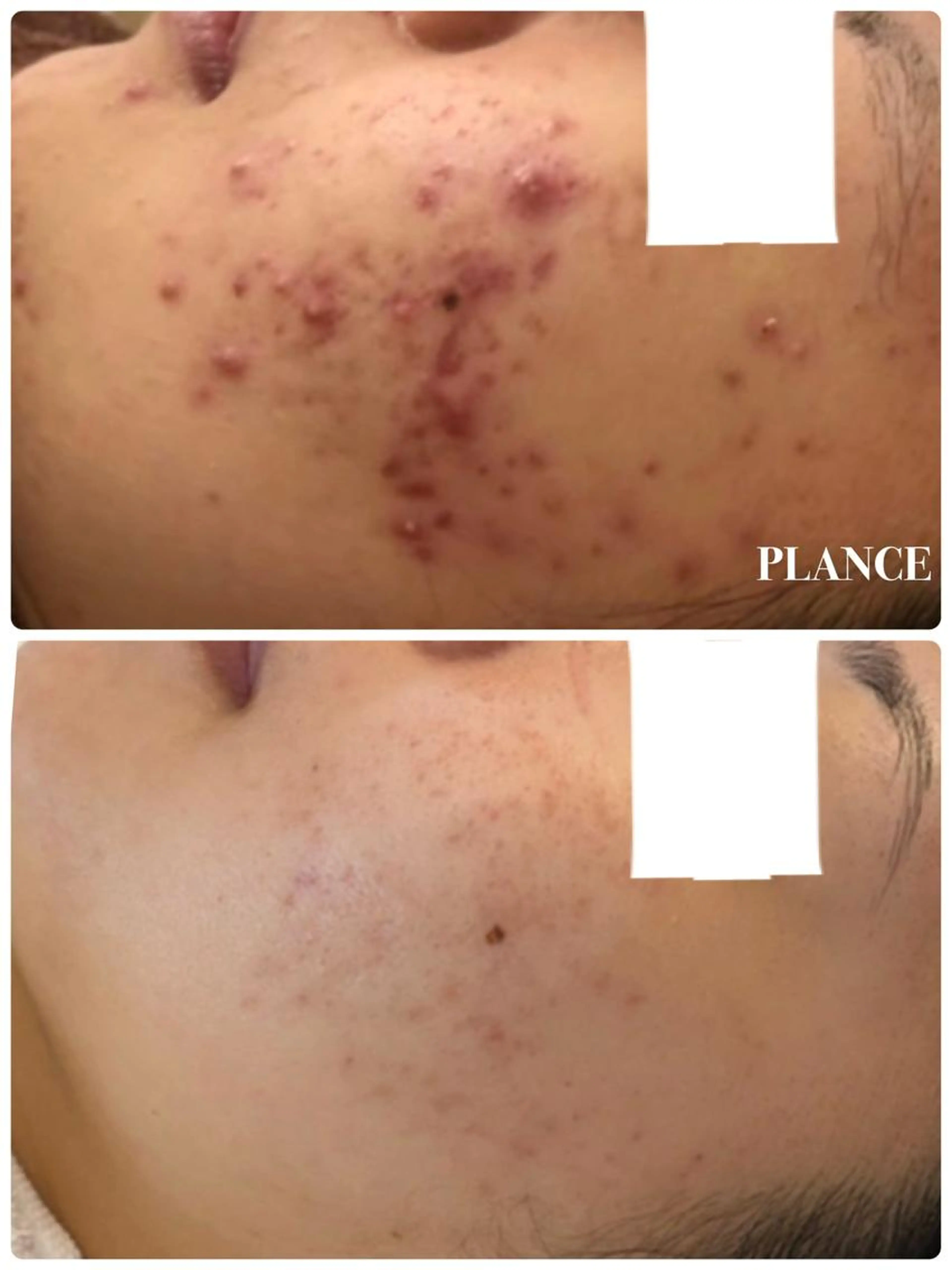 minimo限定価格🌈ニキビ・毛穴改善✨PLANCEニキビケアフェイシャル プレミアム［75分］の写真