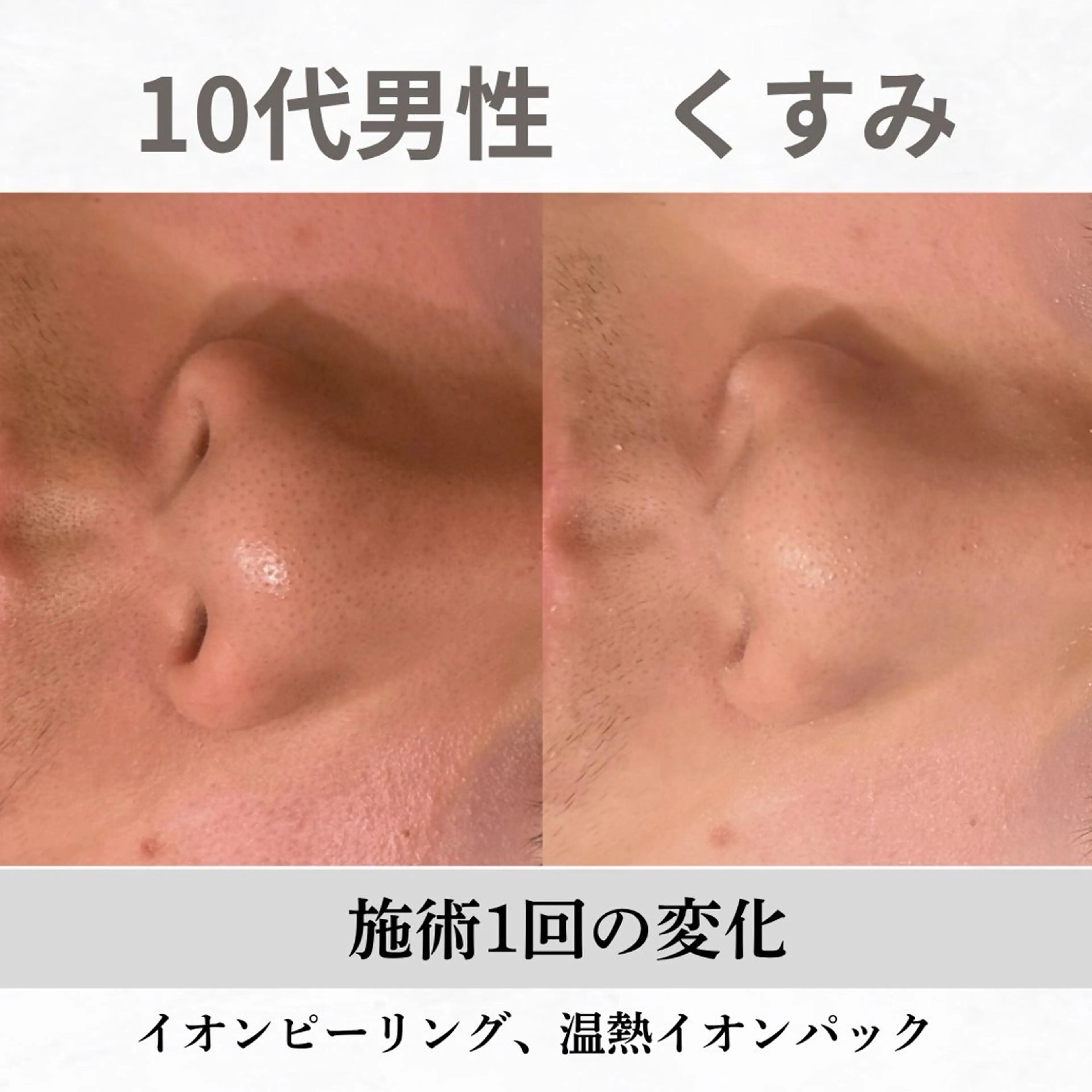 重度ニキビ専門🌷 ダウンタイムなしのエステ・リラクイメージ