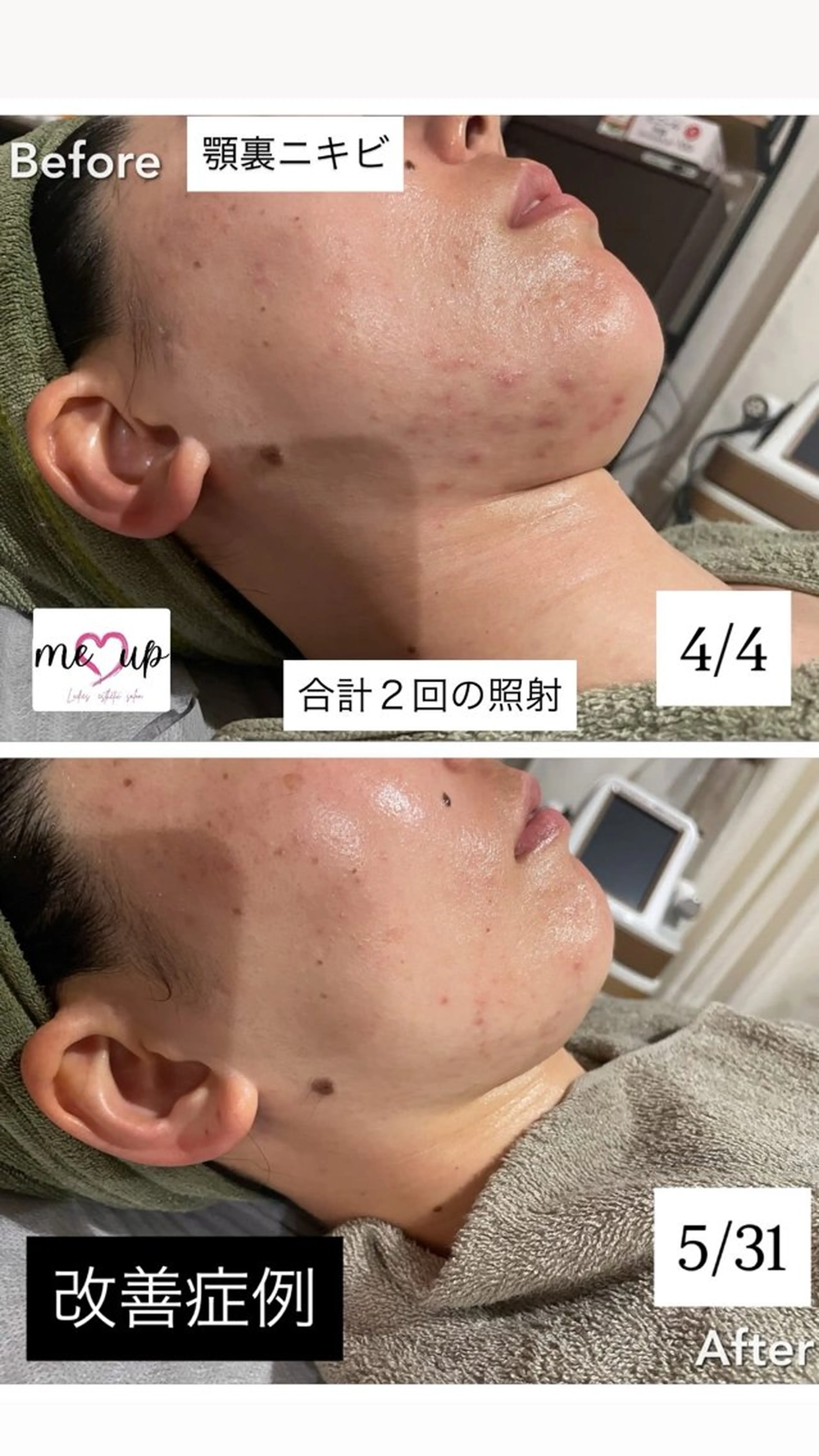 エステ Meupニキビ専門店 背中/ハーブ/肌管理のその他イメージ