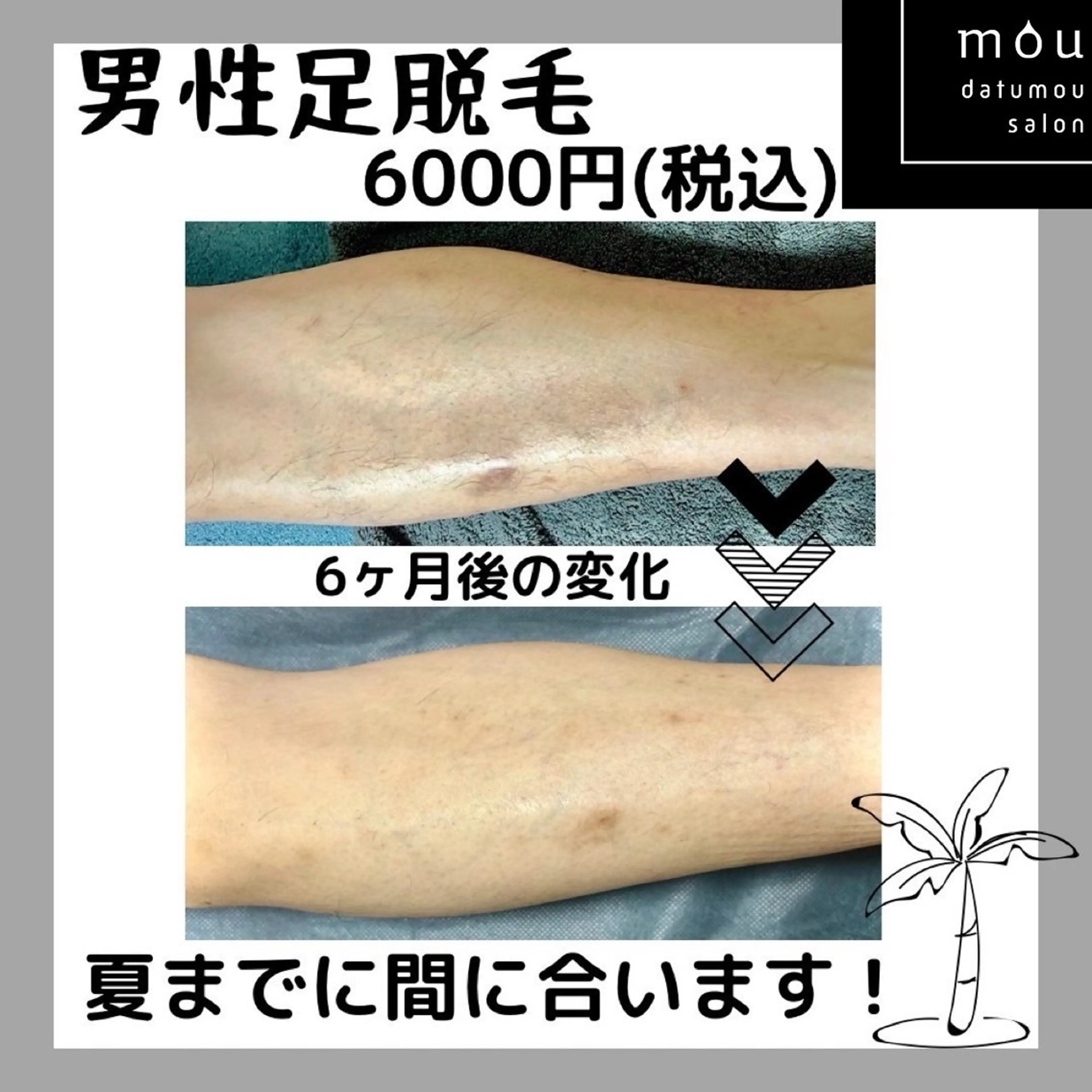 🚹限定❗️脱毛士による丁寧なひざ下脱毛🥼他店で抜けなかった方、初めてで分からない方、丁寧なカウンセリング込みです🤓の写真