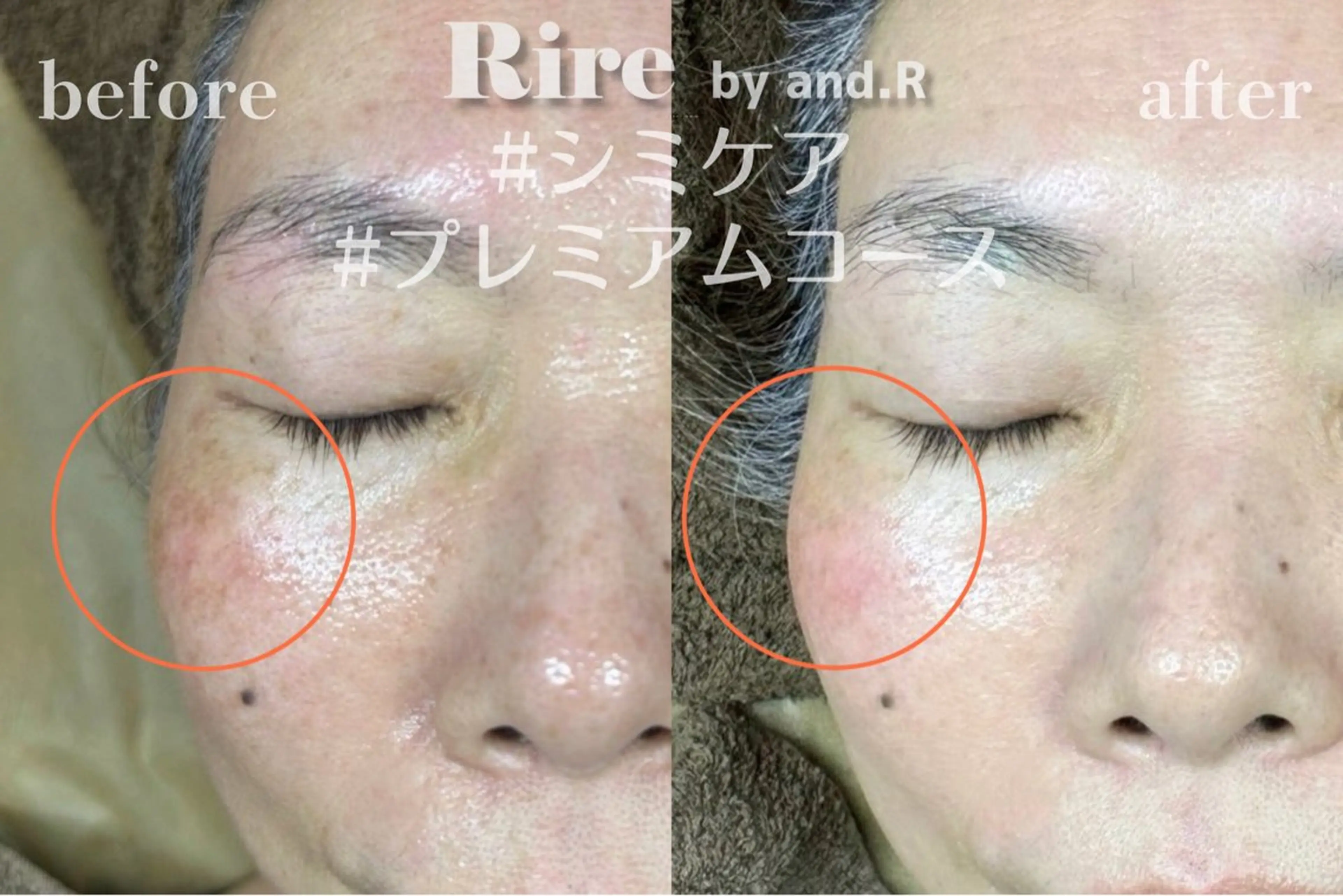 【1ヶ月以内30%OFF】肌質改善シミケア《プレミアムコース》60分¥16,500→¥11550の写真