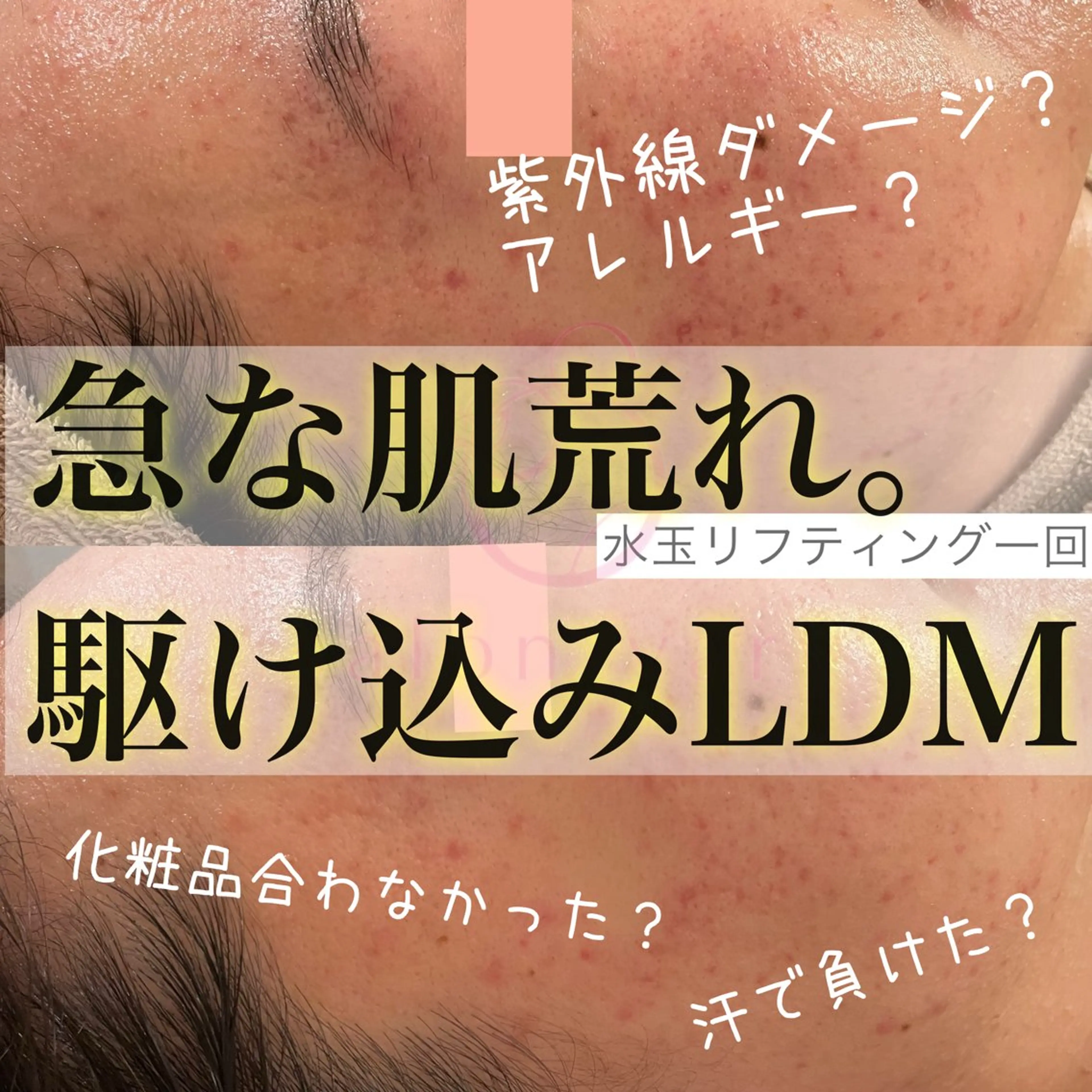 【ニキビ/肌管理】 salon varyのエステ・リラクイメージ