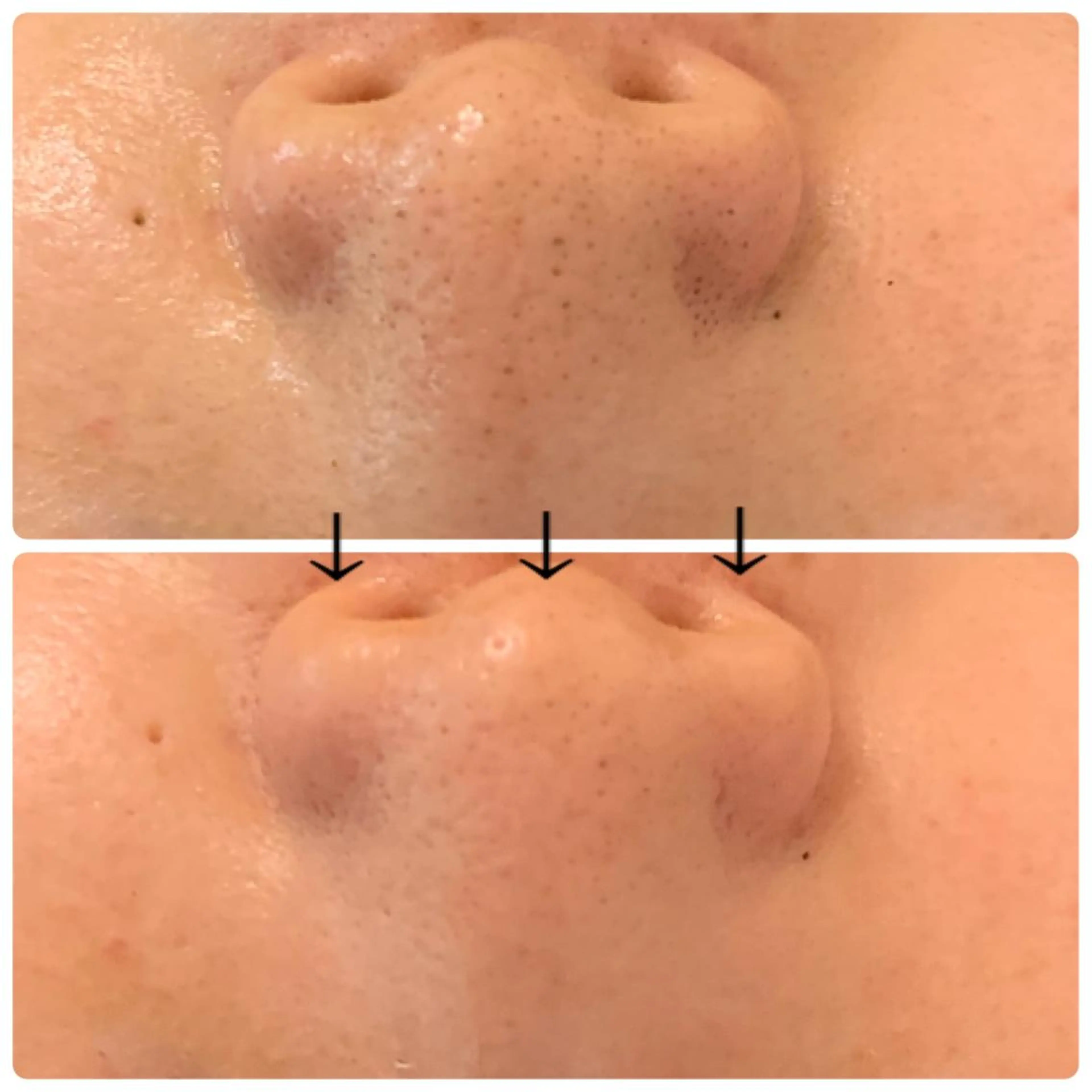 小鼻の黒ずみに☆小鼻ハーブピーリングの写真