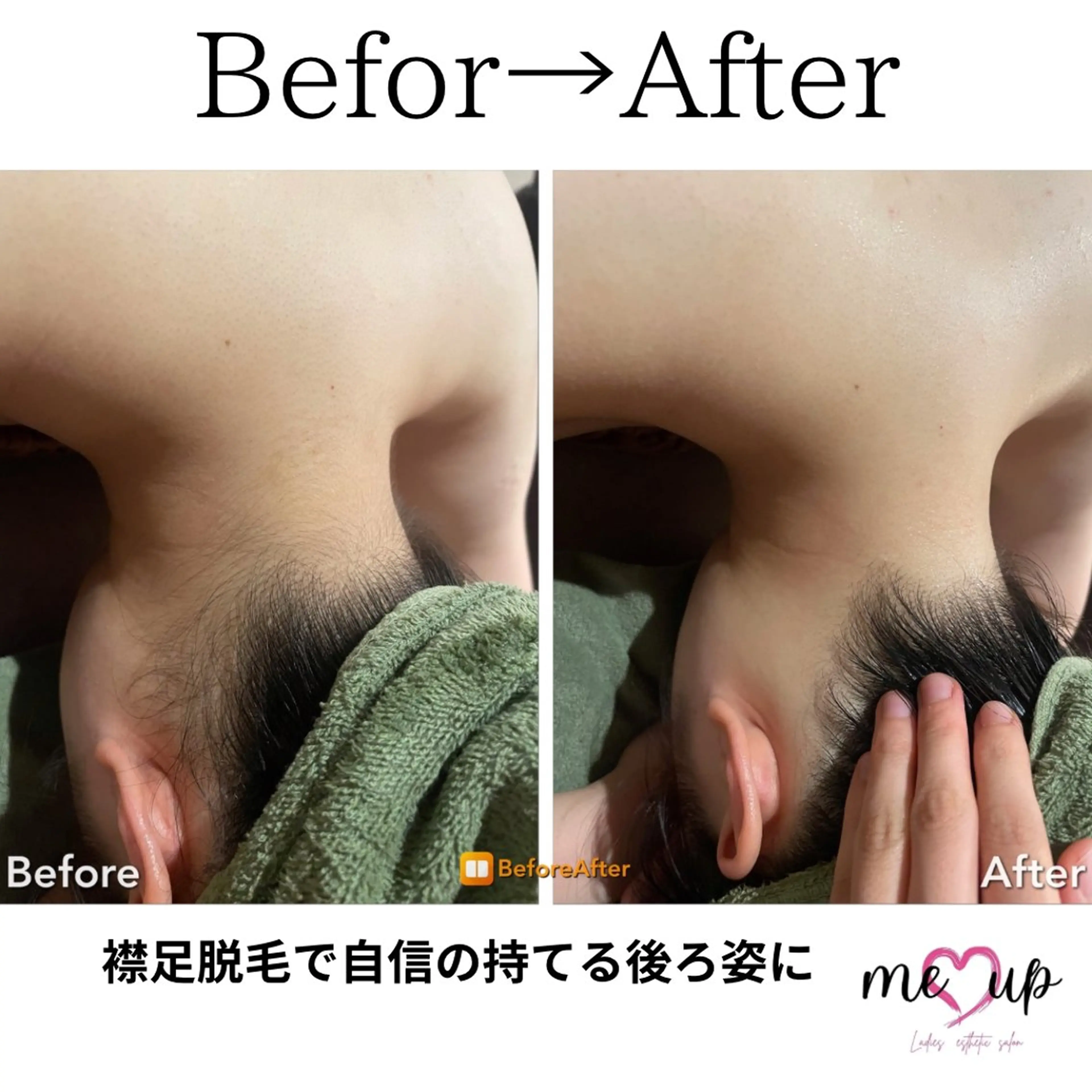 エステ Meupニキビ専門店 背中/ハーブ/肌管理のその他イメージ