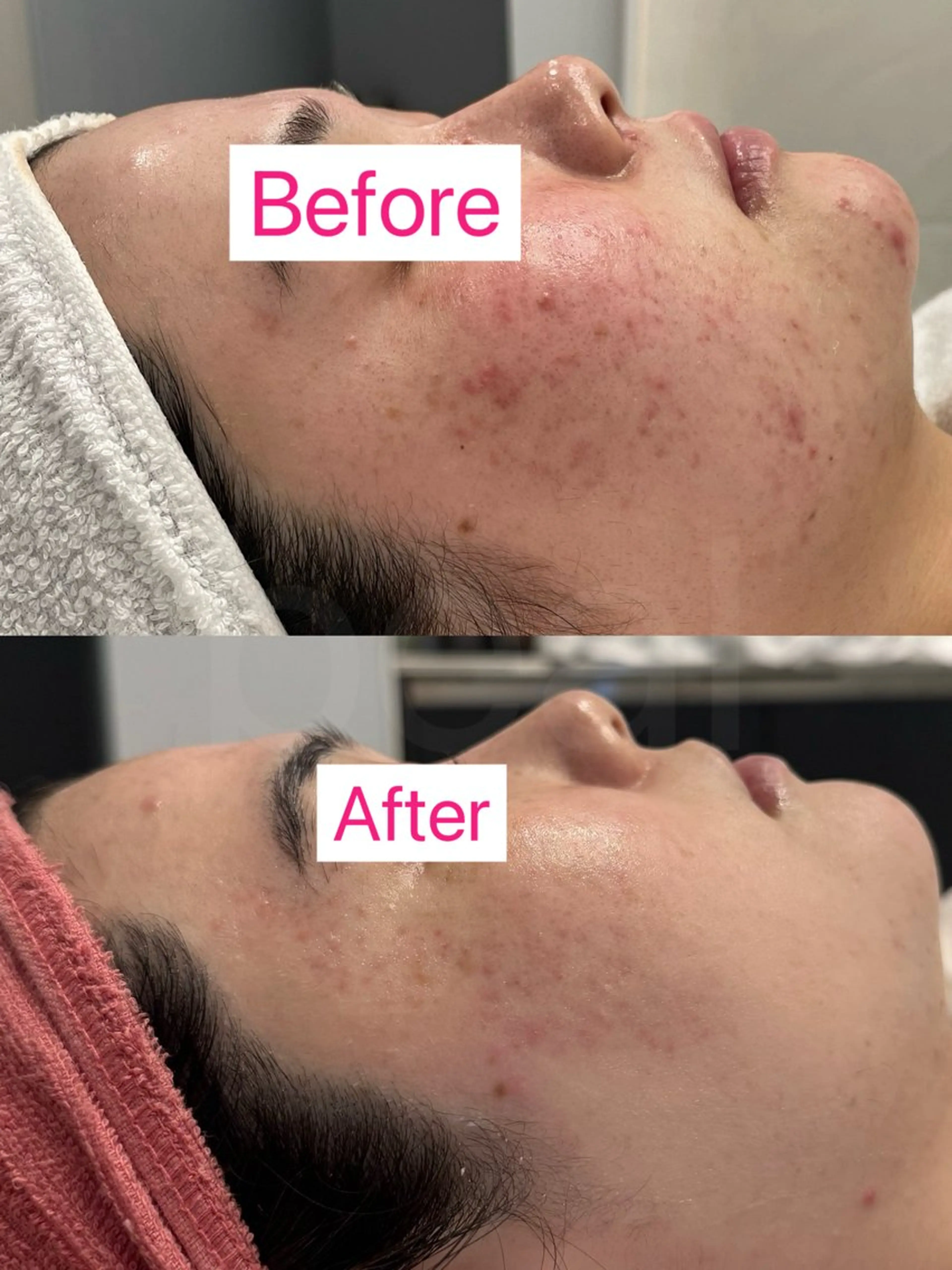 べアール所属・小顔/毛穴/ニキビ salon bealのエステ・リラクイメージ