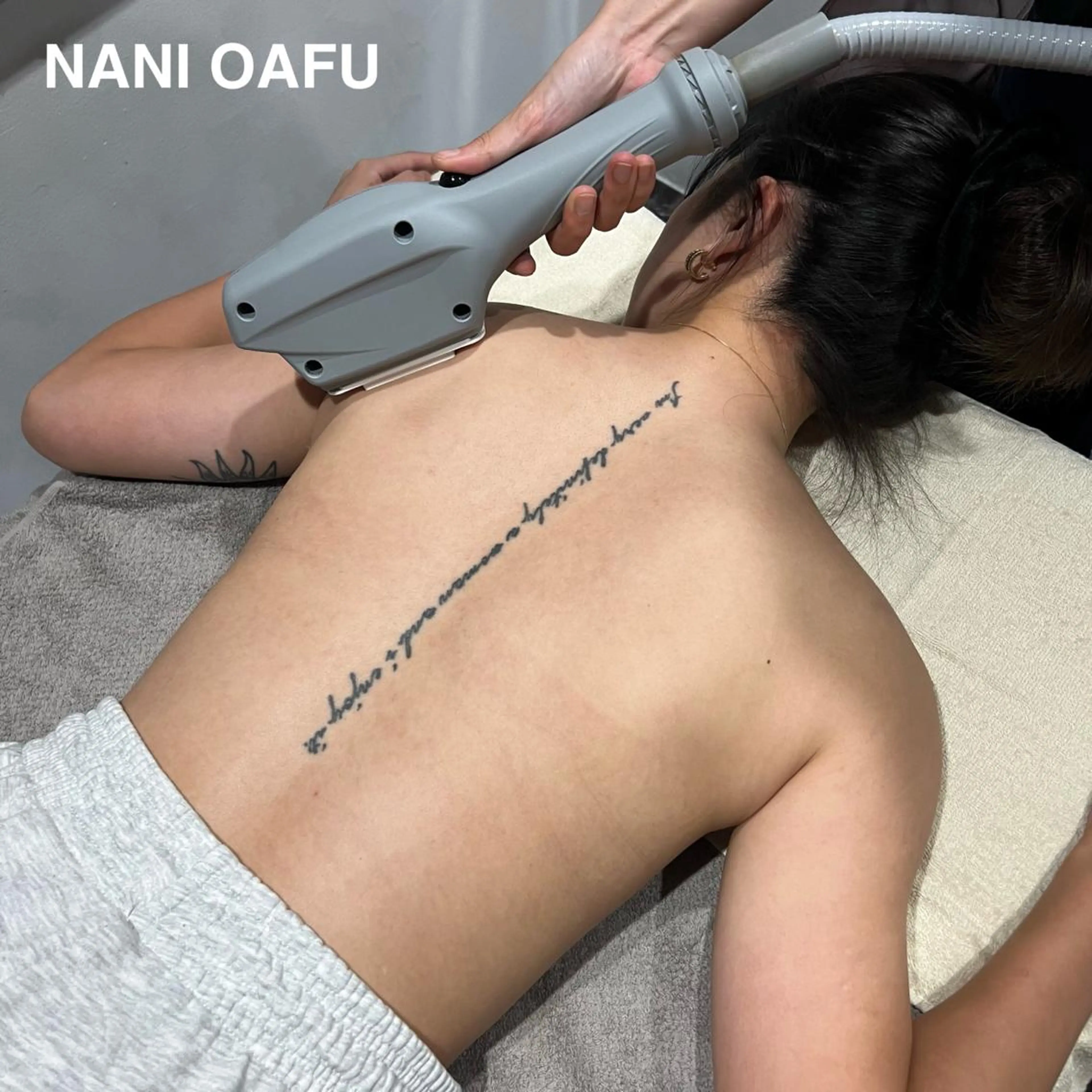 【背中まるごと脱毛🤍】襟足＋背中上下＋腰｜産毛・毛穴・肌質改善に◎メンズOK・都度払い可能の写真