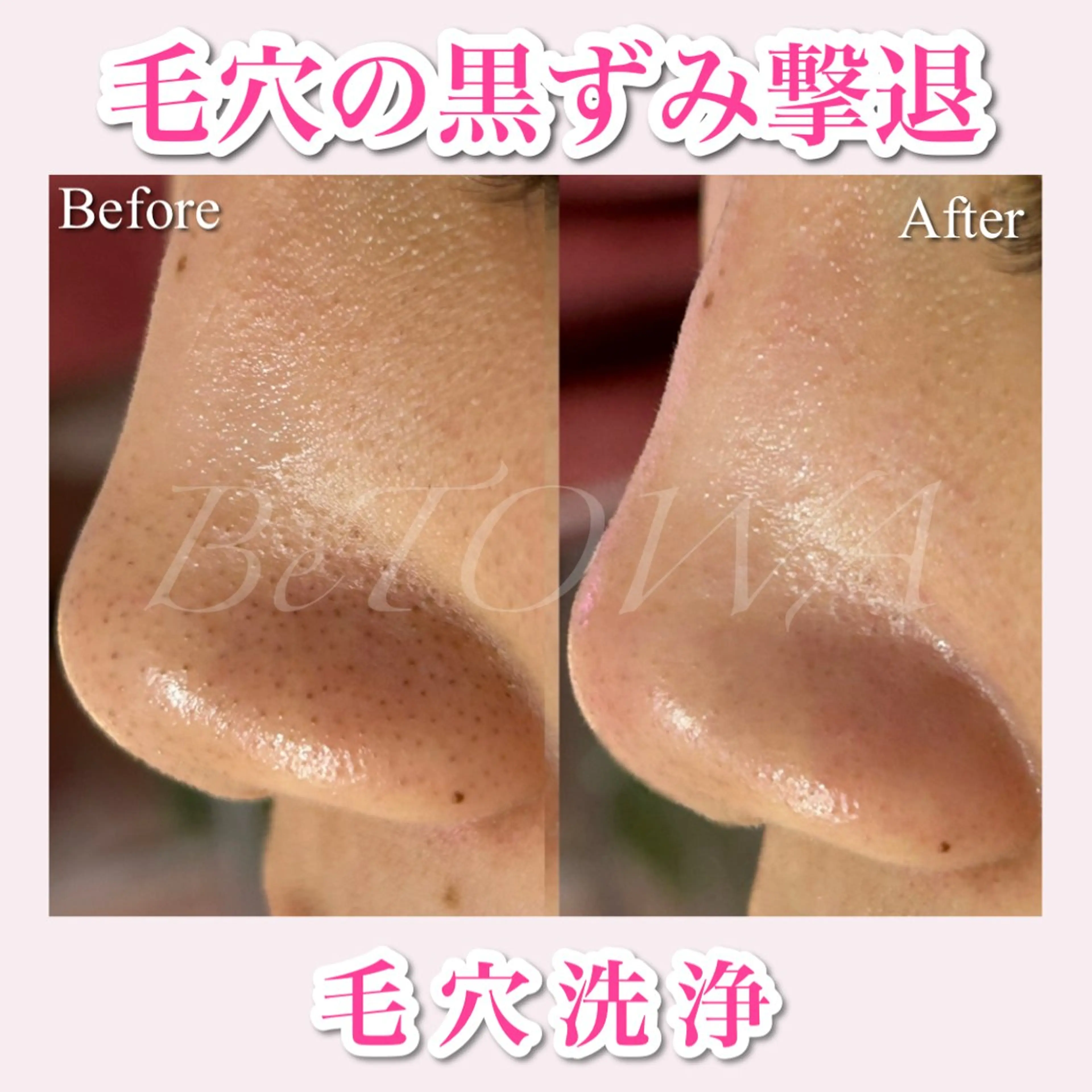 ※当日限定【毛穴洗浄撃退+幹細胞ケア】SNSモニターモデル✨🧢メンズOKの写真