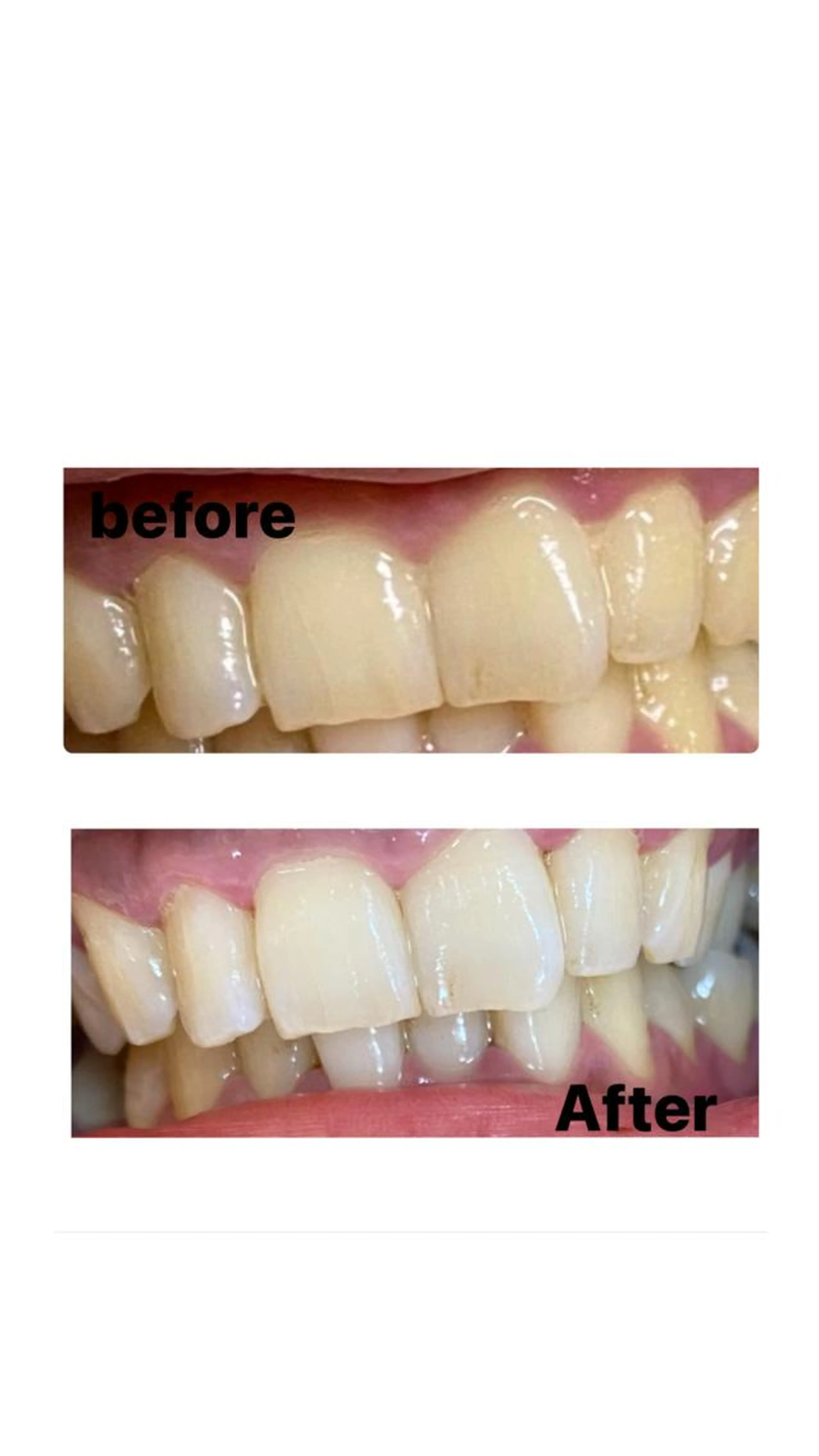 🦷セルフホワイトニング！8分照射2セット ✨初めての方におすすめコース✨ネイルと空き時間違う為お問い合わせください☺️の写真