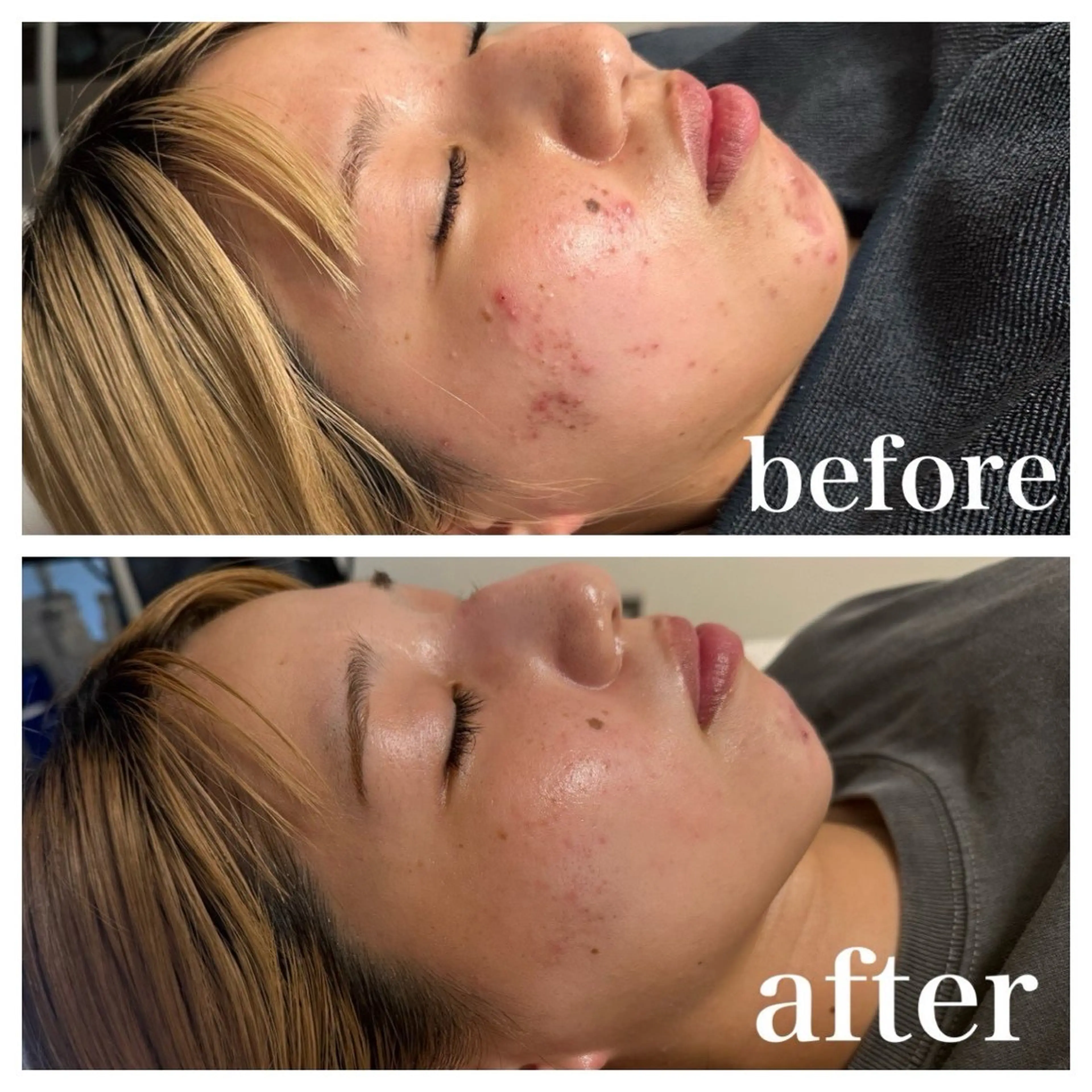 小顔・毛穴/ニキビ/ ハーブピーリング専門のエステ・リラクイメージ